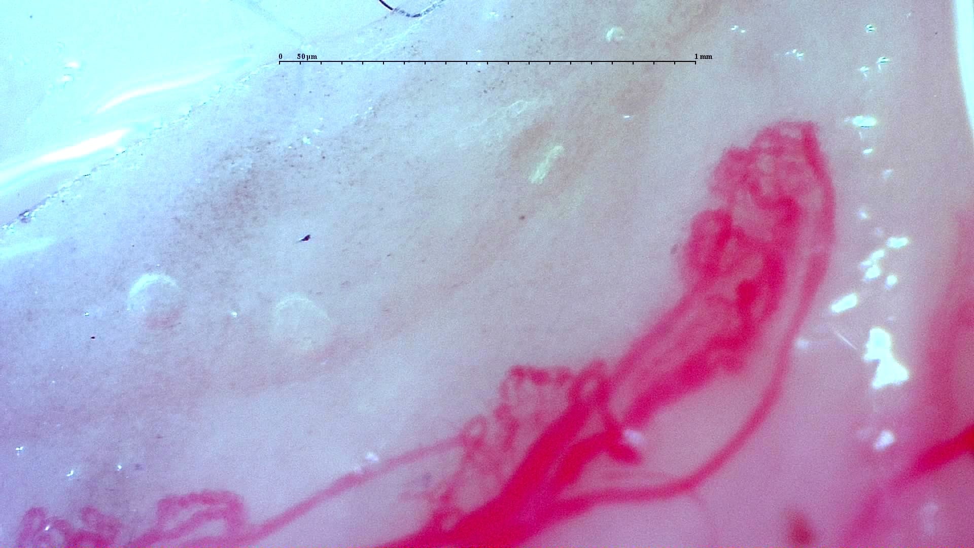 Nailfold capillaroscopy: right little finger, field b. Anti-TIF1γ Dermatomyositis with Scleroderma-Like Pattern.