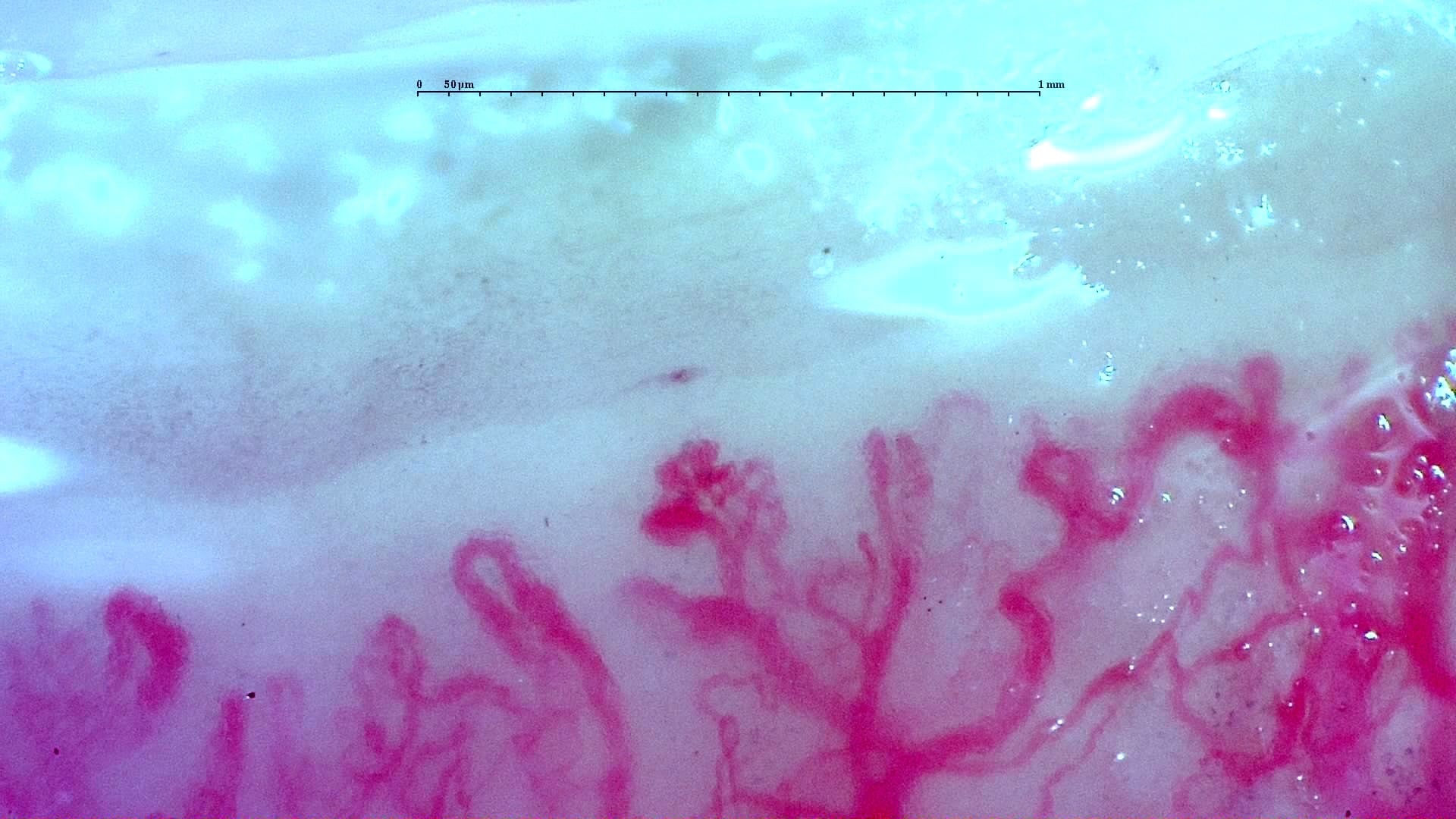 Nailfold capillaroscopy: left ring finger, field b. Anti-TIF1γ Dermatomyositis with Scleroderma-Like Pattern.
