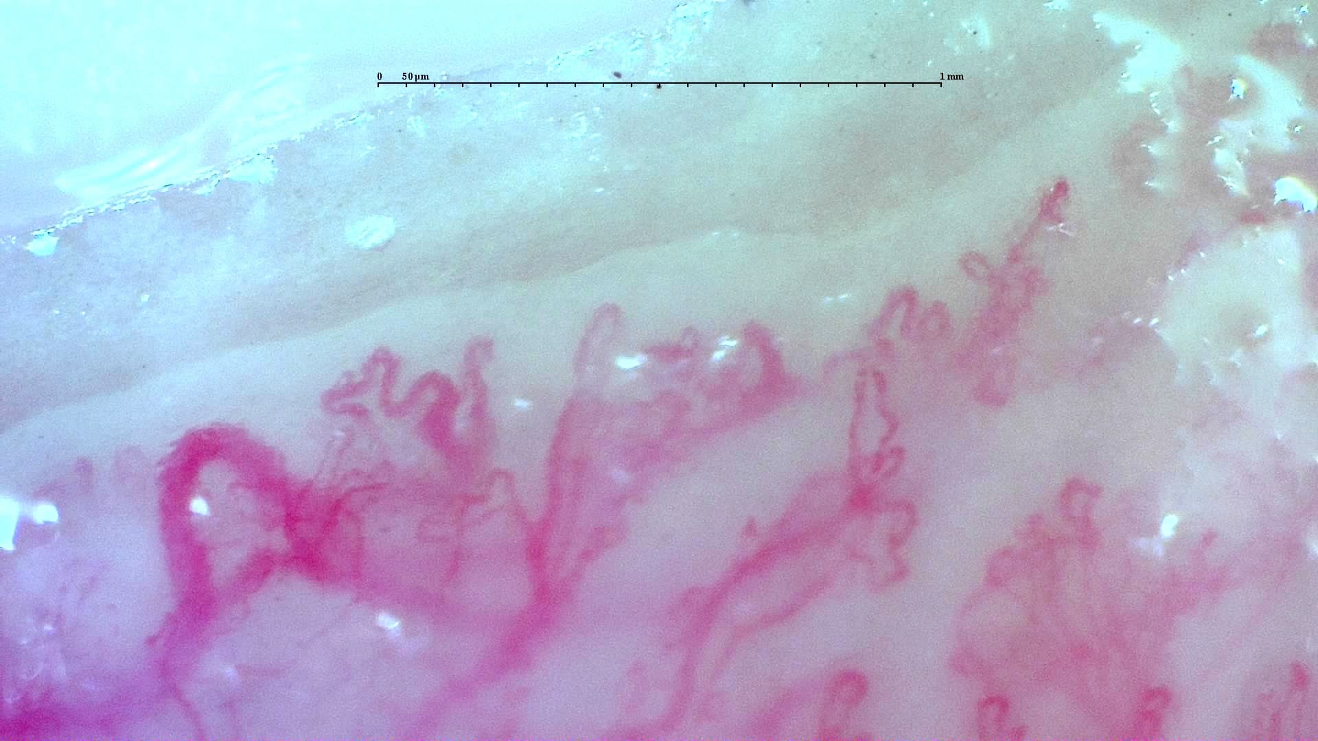 Nailfold capillaroscopy: left index finger, field b. Anti-TIF1γ Dermatomyositis with Scleroderma-Like Pattern.