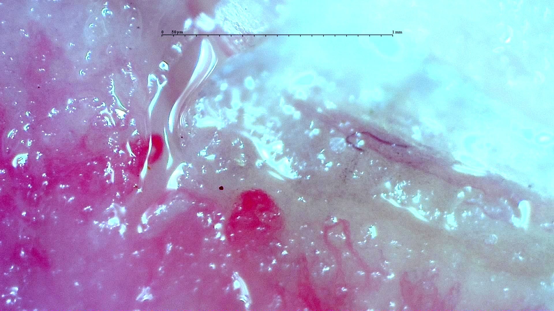 Nailfold capillaroscopy: right middle finger, field b. Anti-TIF1γ Dermatomyositis with Scleroderma-Like Pattern.