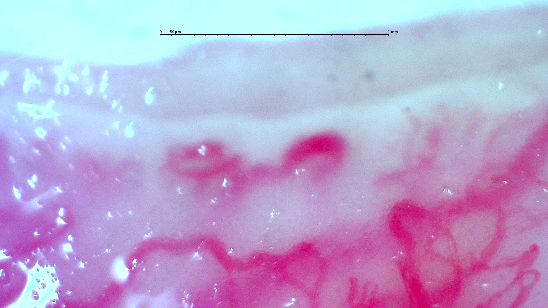 Nailfold capillaroscopy: right index finger, field b. Anti-TIF1γ Dermatomyositis with Scleroderma-Like Pattern.