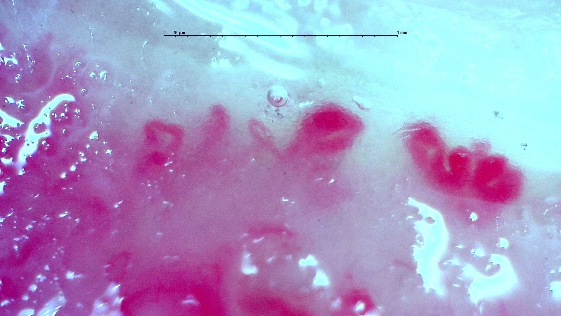 Nailfold capillaroscopy: right middle finger, field d. Anti-TIF1γ Dermatomyositis with Scleroderma-Like Pattern.