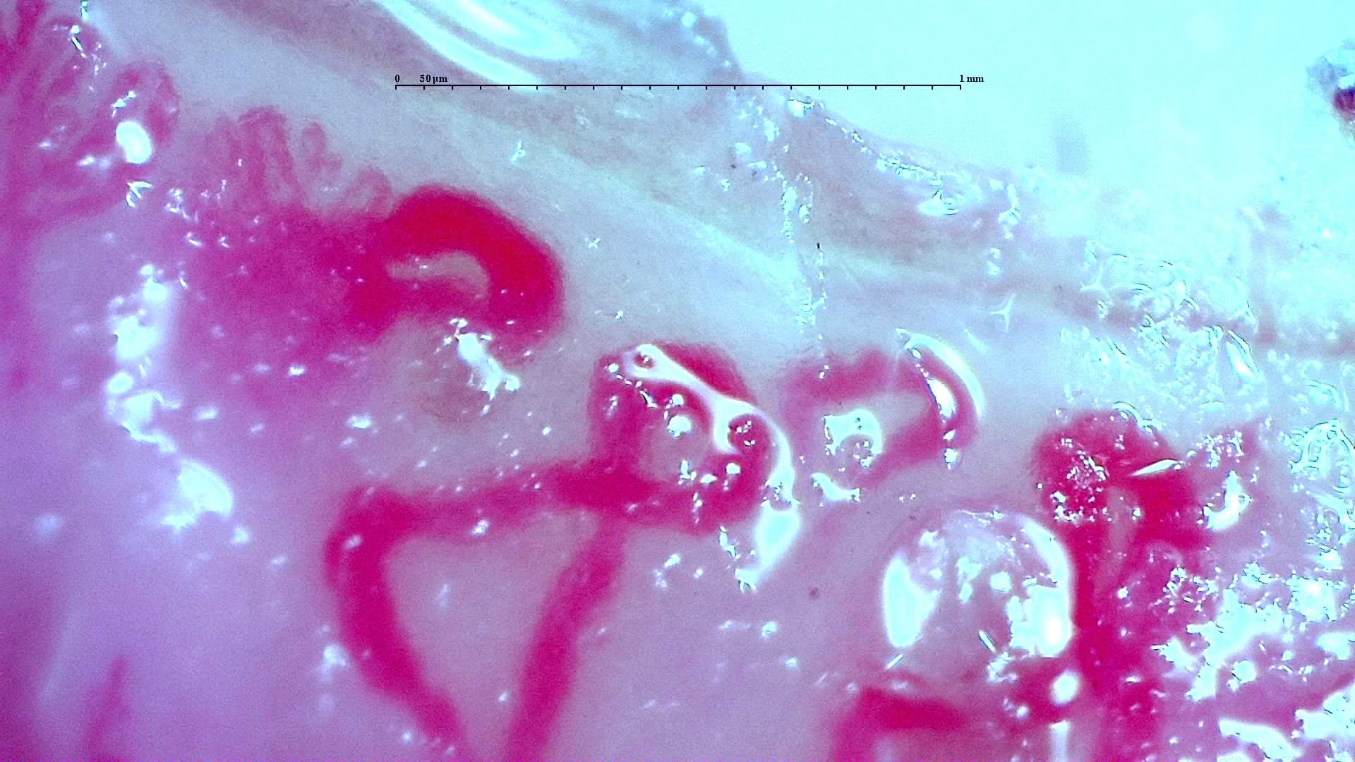 Nailfold capillaroscopy: right index finger, field c. Anti-TIF1γ Dermatomyositis with Scleroderma-Like Pattern.