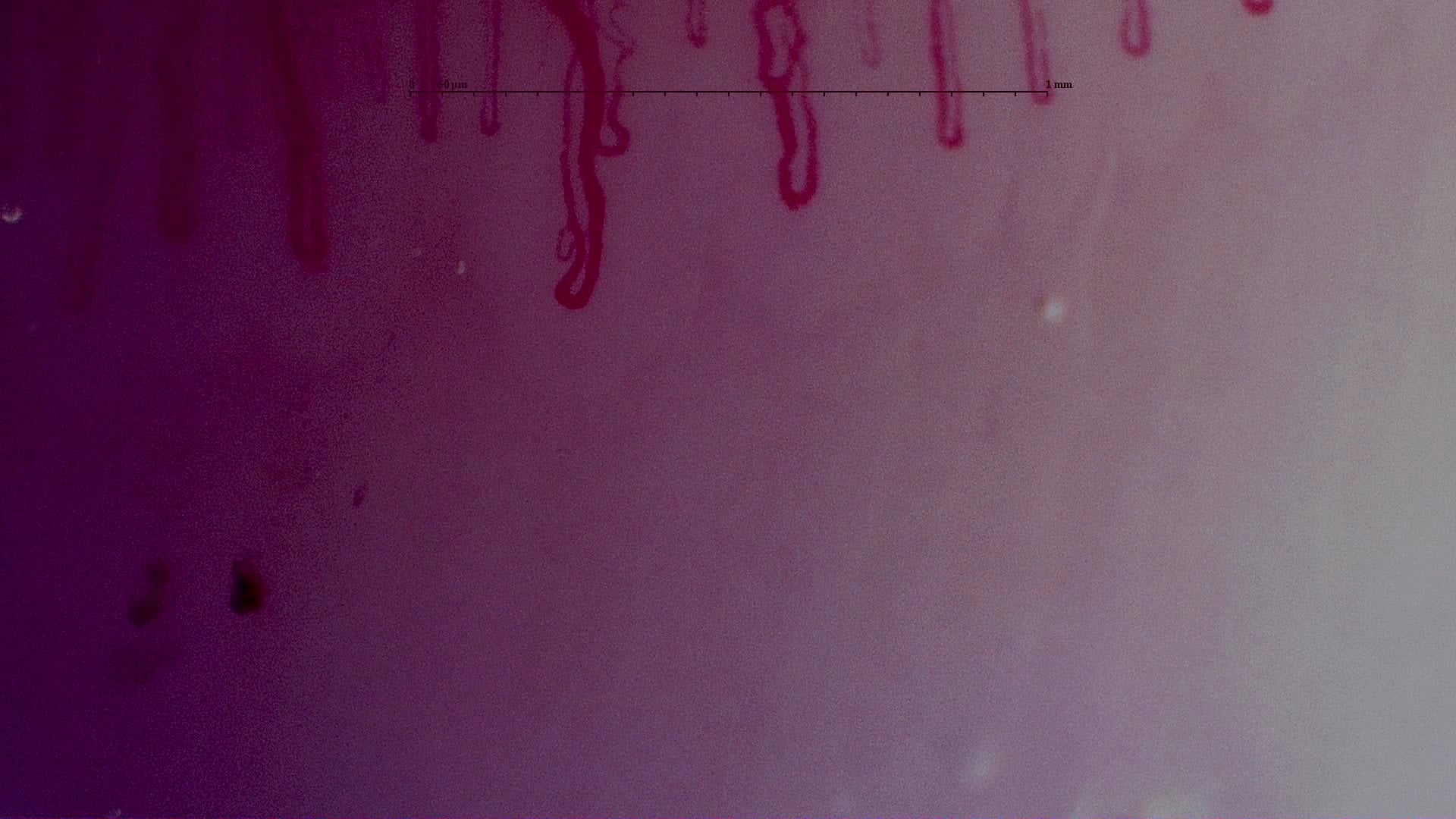 Nailfold capillaroscopy: left ring finger, field a. MPO-ANCA Vasculitis with Rapidly Progressive Glomerulonephritis.