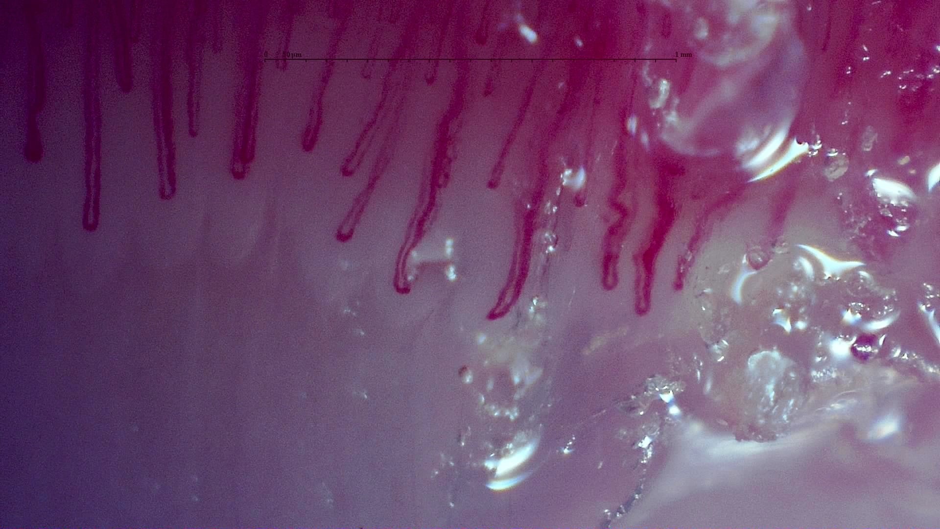 Nailfold capillaroscopy: left ring finger, field d. MPO-ANCA Vasculitis with Rapidly Progressive Glomerulonephritis.