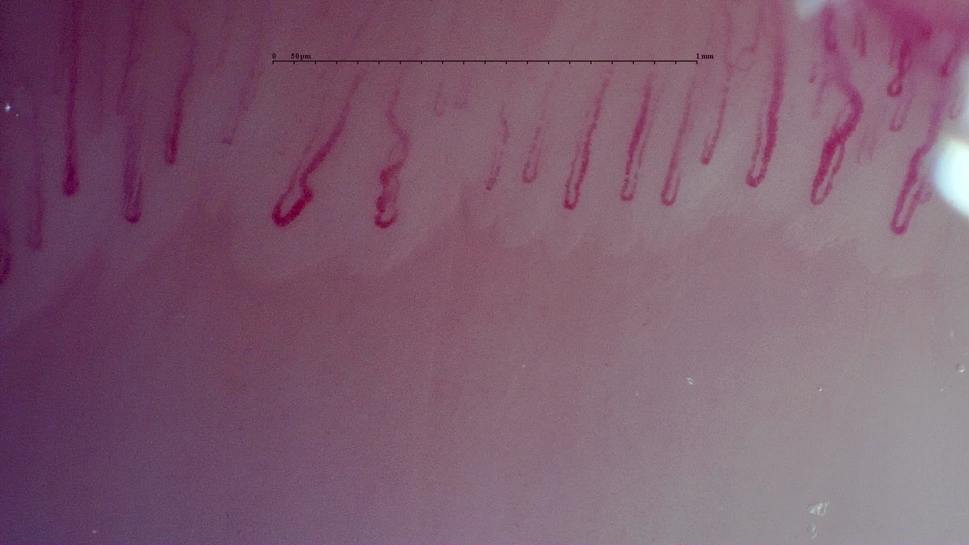 Nailfold capillaroscopy: left middle finger, field b. MPO-ANCA Vasculitis with Rapidly Progressive Glomerulonephritis.
