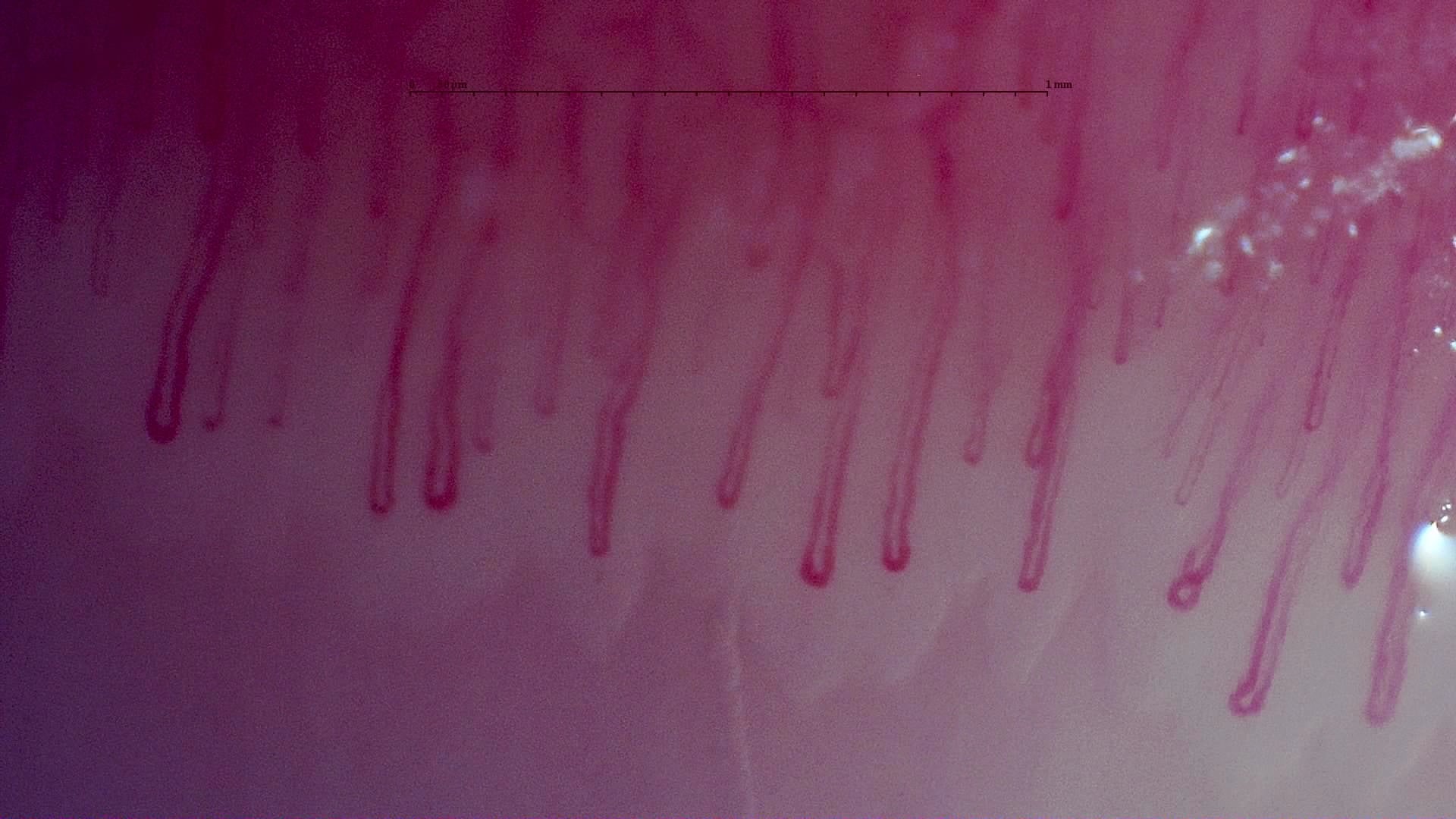 Nailfold capillaroscopy: left middle finger, field c. MPO-ANCA Vasculitis with Rapidly Progressive Glomerulonephritis.