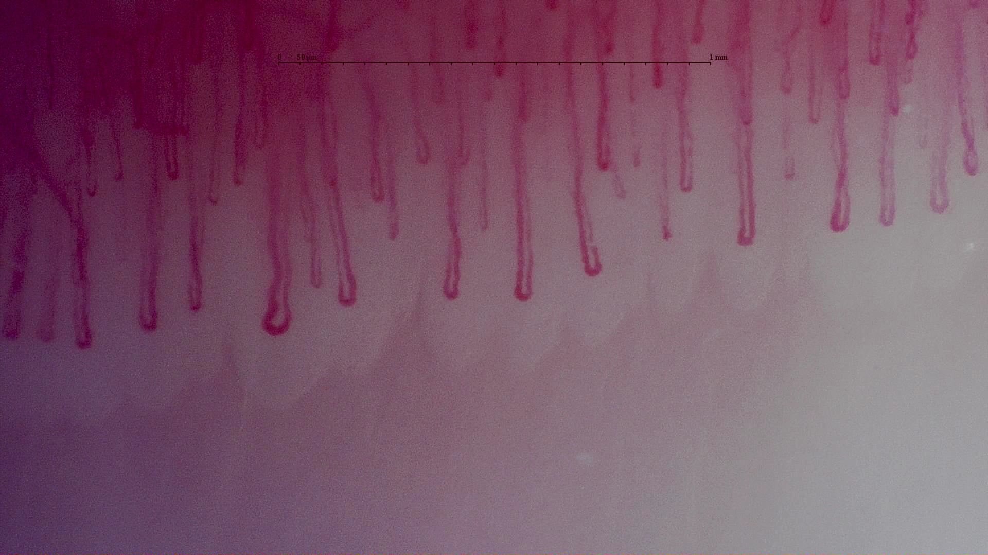 Nailfold capillaroscopy: right middle finger, field c. MPO-ANCA Vasculitis with Rapidly Progressive Glomerulonephritis.