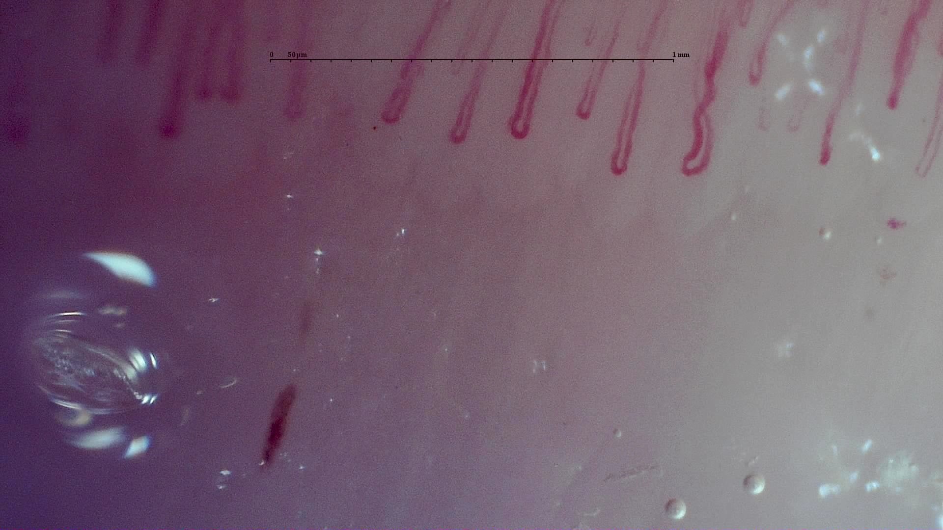 Nailfold capillaroscopy: right ring finger, field d. MPO-ANCA Vasculitis with Rapidly Progressive Glomerulonephritis.
