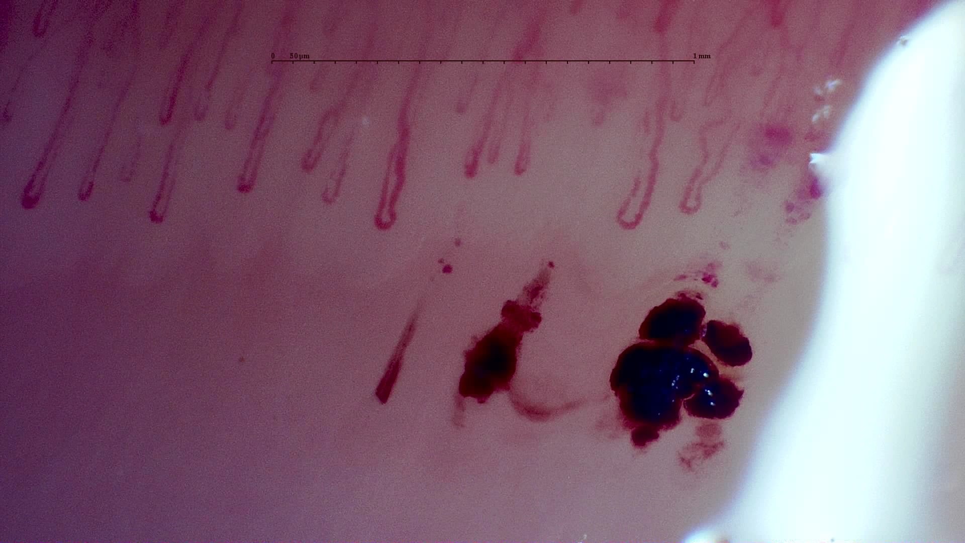 Large dark hemorrhagic deposits below the capillary row in the published MPO-ANCA vasculitis case. Its complete study is described as a nonspecific pattern without giants.