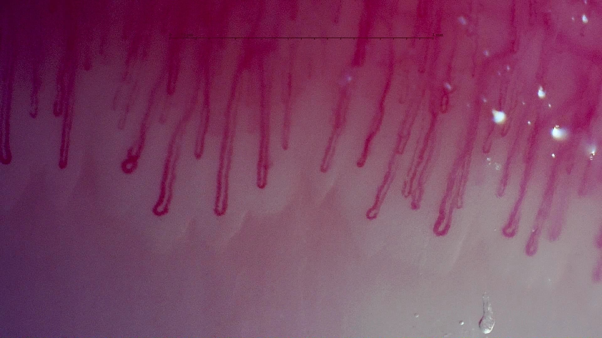 Nailfold capillaroscopy: left middle finger, field d. MPO-ANCA Vasculitis with Rapidly Progressive Glomerulonephritis.