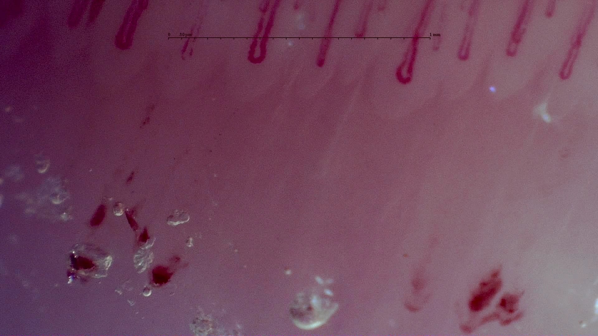 Nailfold capillaroscopy: left index finger, field a. MPO-ANCA Vasculitis with Rapidly Progressive Glomerulonephritis.