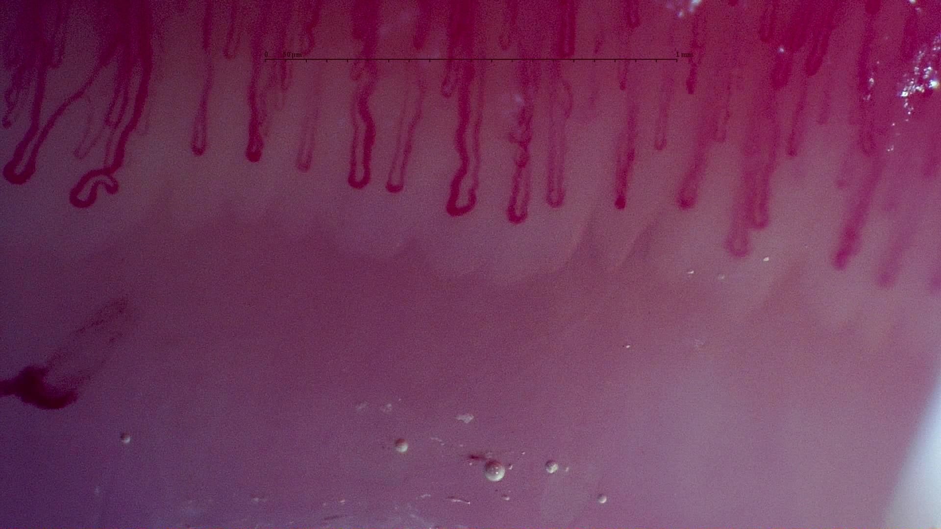 Nailfold capillaroscopy: right index finger, field b. MPO-ANCA Vasculitis with Rapidly Progressive Glomerulonephritis.