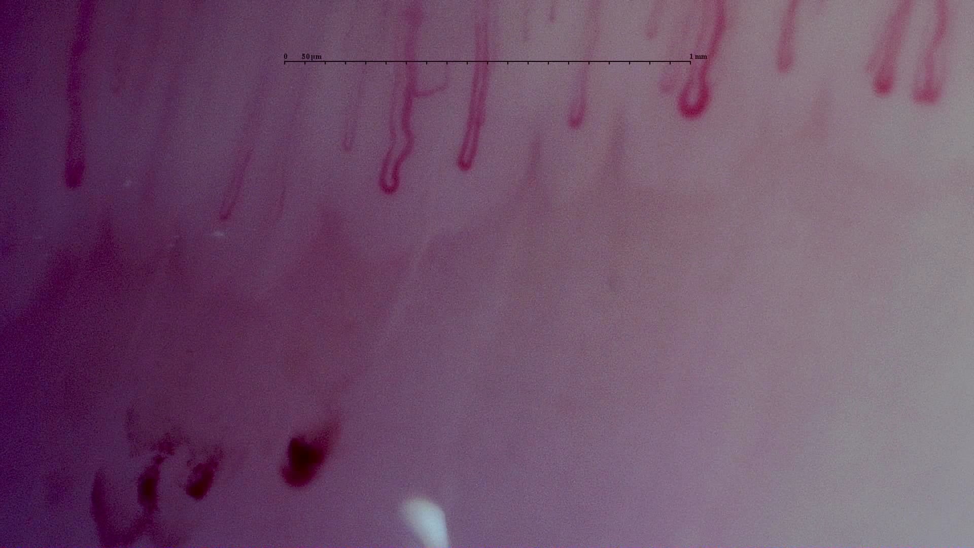 Nailfold capillaroscopy: right middle finger, field d. MPO-ANCA Vasculitis with Rapidly Progressive Glomerulonephritis.