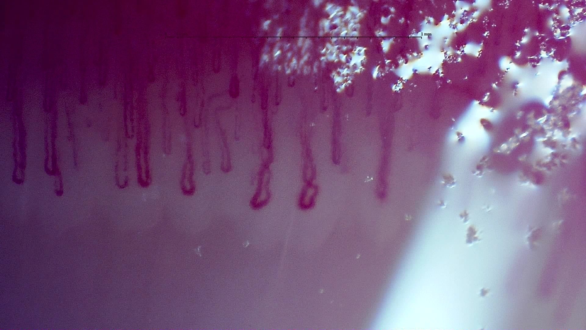 Nailfold capillaroscopy: right middle finger, field b. MPO-ANCA Vasculitis with Rapidly Progressive Glomerulonephritis.