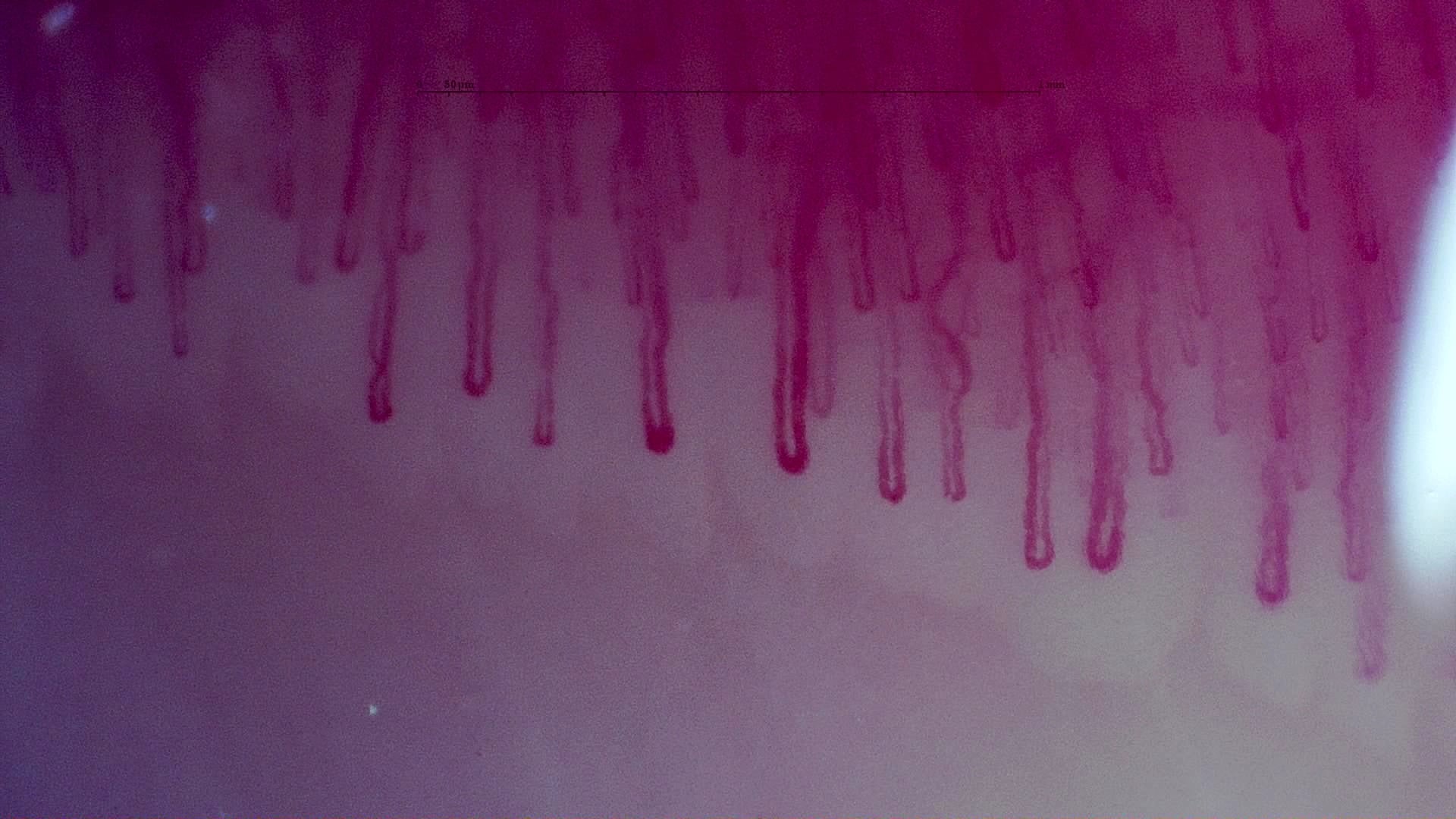 Nailfold capillaroscopy: right middle finger, field a. MPO-ANCA Vasculitis with Rapidly Progressive Glomerulonephritis.