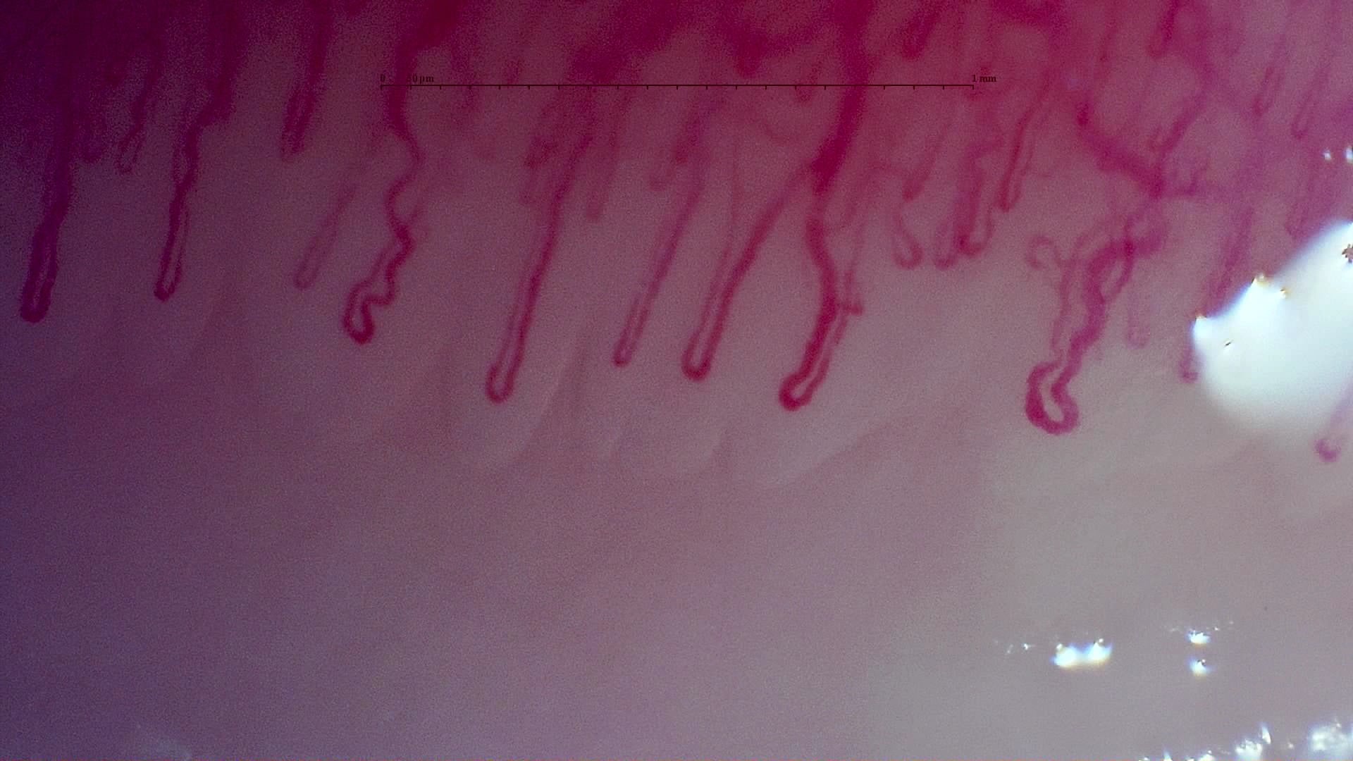 Nailfold capillaroscopy: left little finger, field c. MPO-ANCA Vasculitis with Rapidly Progressive Glomerulonephritis.