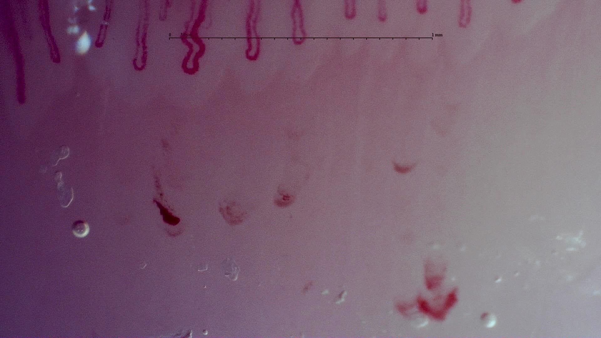 Nailfold capillaroscopy: left middle finger, field a. MPO-ANCA Vasculitis with Rapidly Progressive Glomerulonephritis.