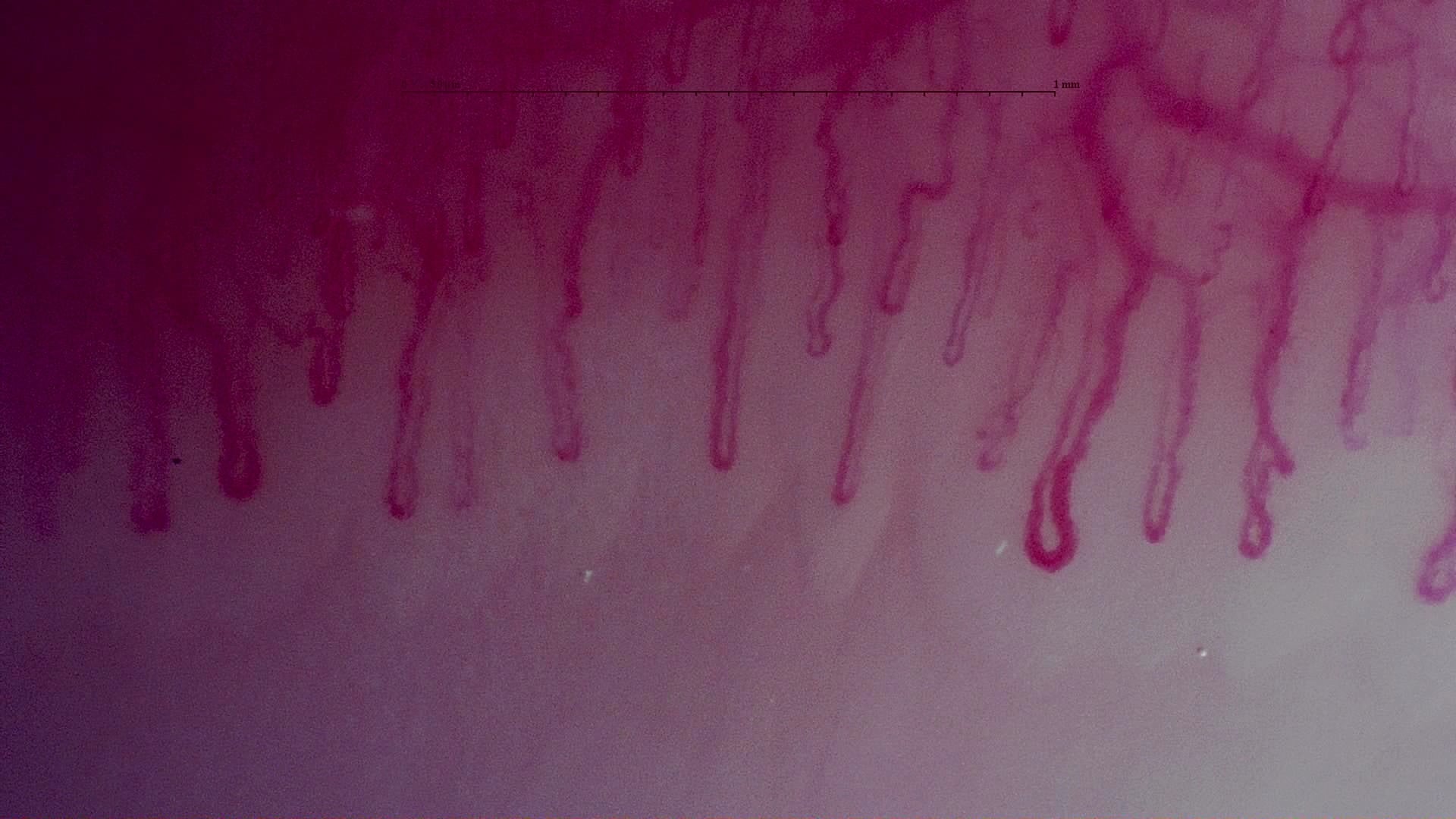 Nailfold capillaroscopy: left little finger, field b. MPO-ANCA Vasculitis with Rapidly Progressive Glomerulonephritis.