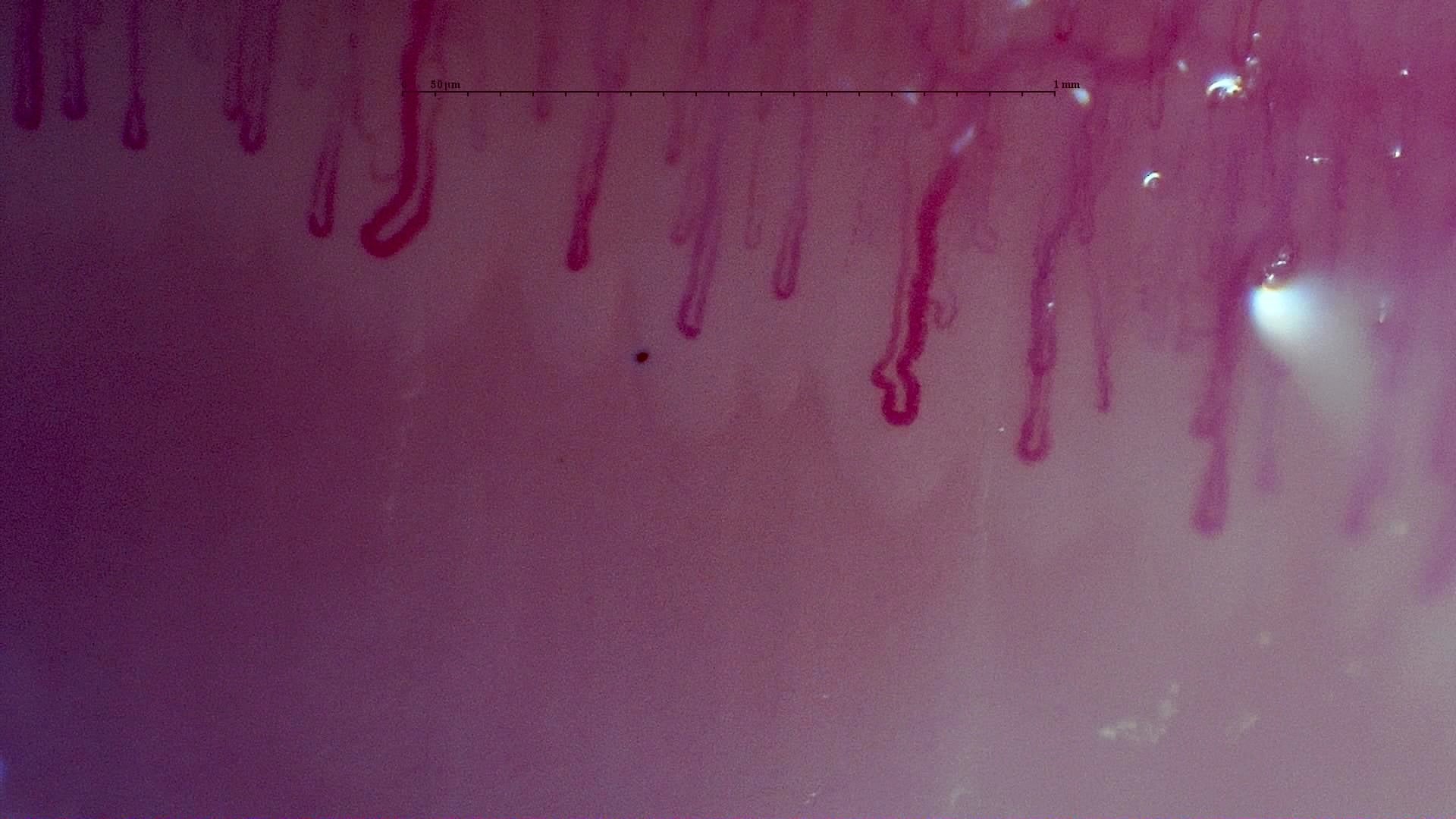 Nailfold capillaroscopy: left index finger, field c. MPO-ANCA Vasculitis with Rapidly Progressive Glomerulonephritis.