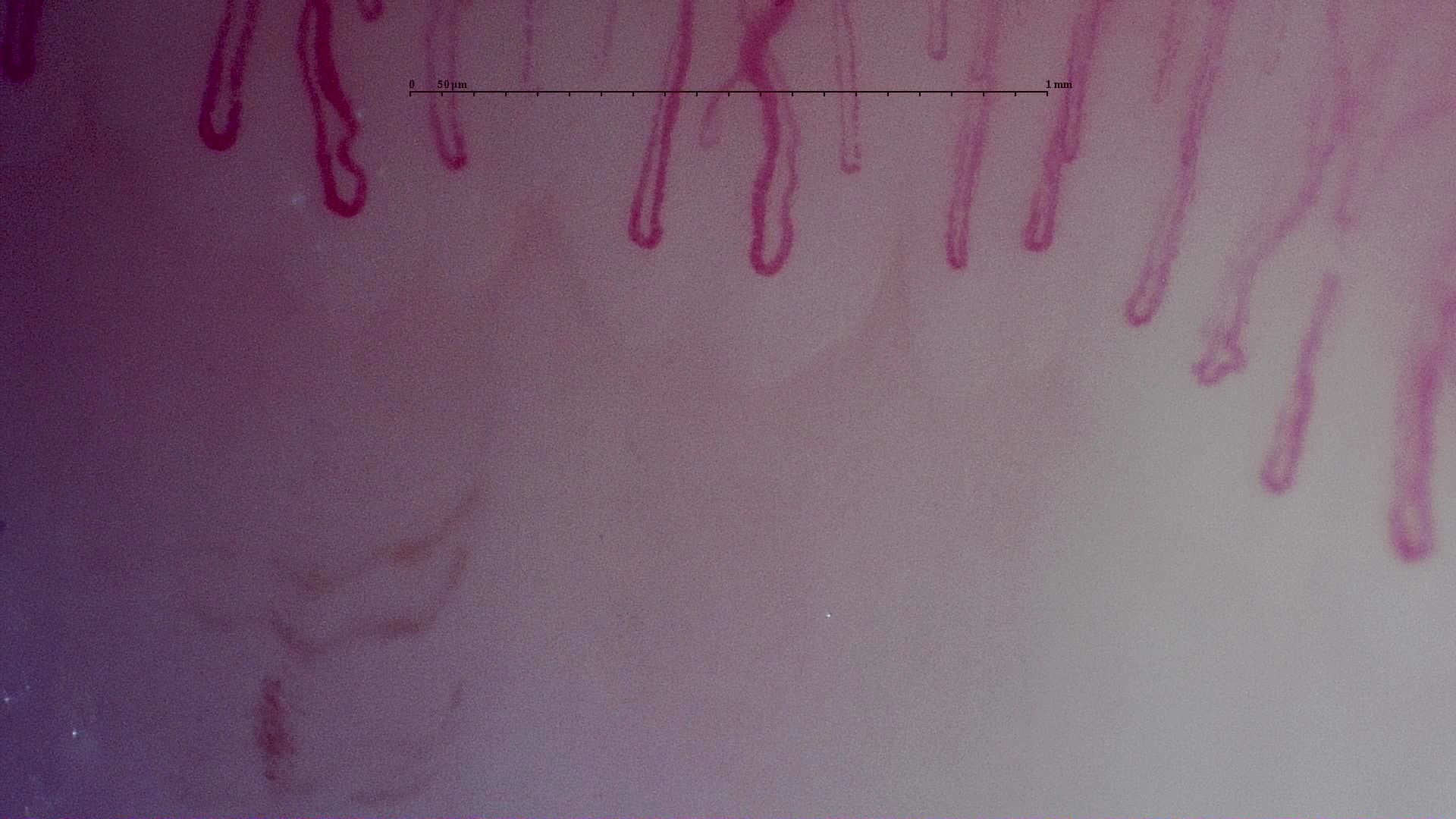Nailfold capillaroscopy: right ring finger, field b. MPO-ANCA Vasculitis with Rapidly Progressive Glomerulonephritis.