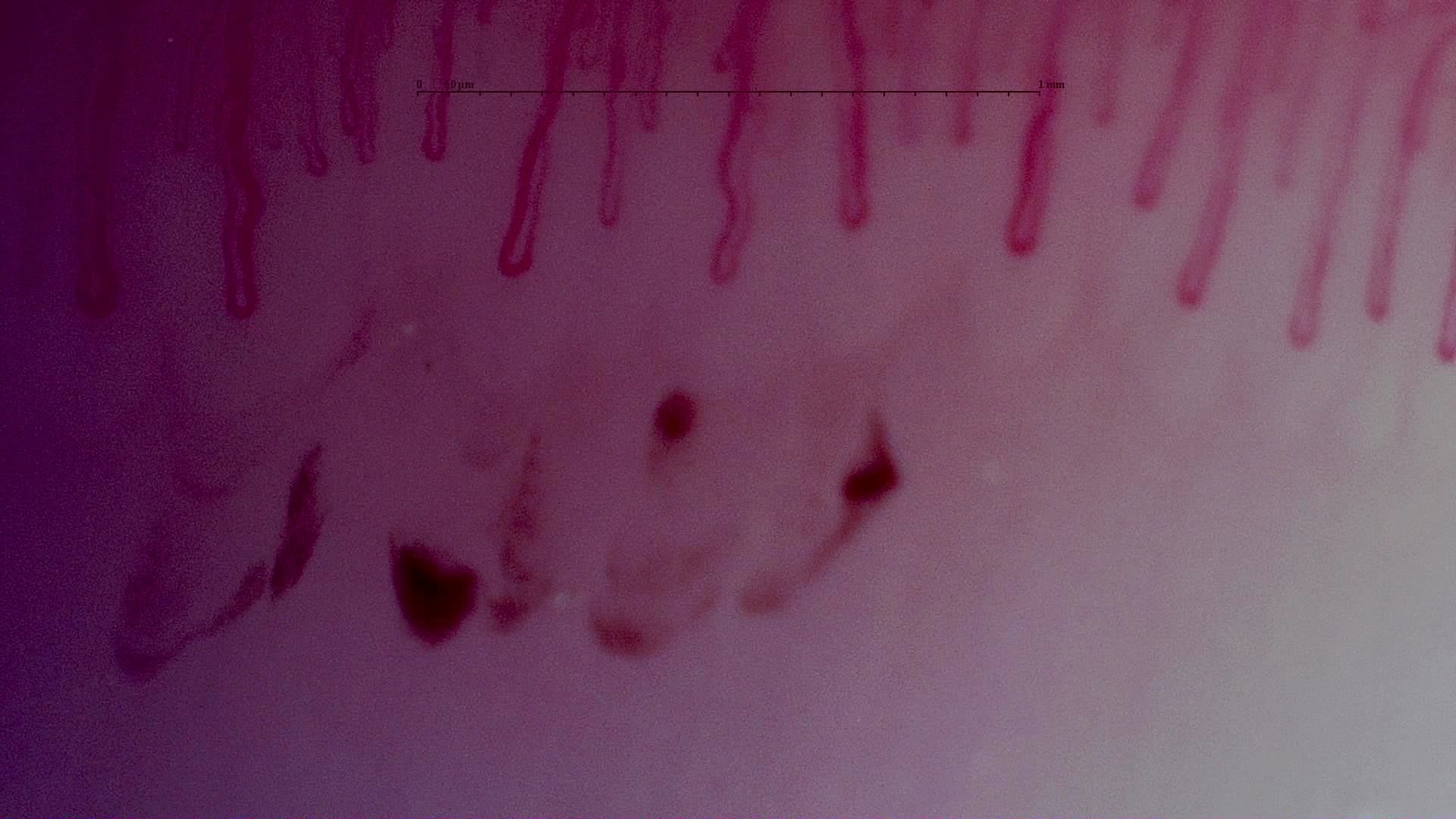 Nailfold capillaroscopy: right little finger, field d. MPO-ANCA Vasculitis with Rapidly Progressive Glomerulonephritis.