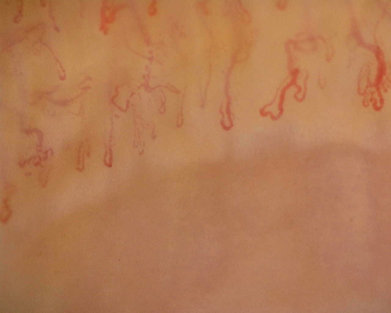 Nailfold capillaroscopy: left ring finger, field b. Anti-Mi2β Dermatomyositis in Active Disease.