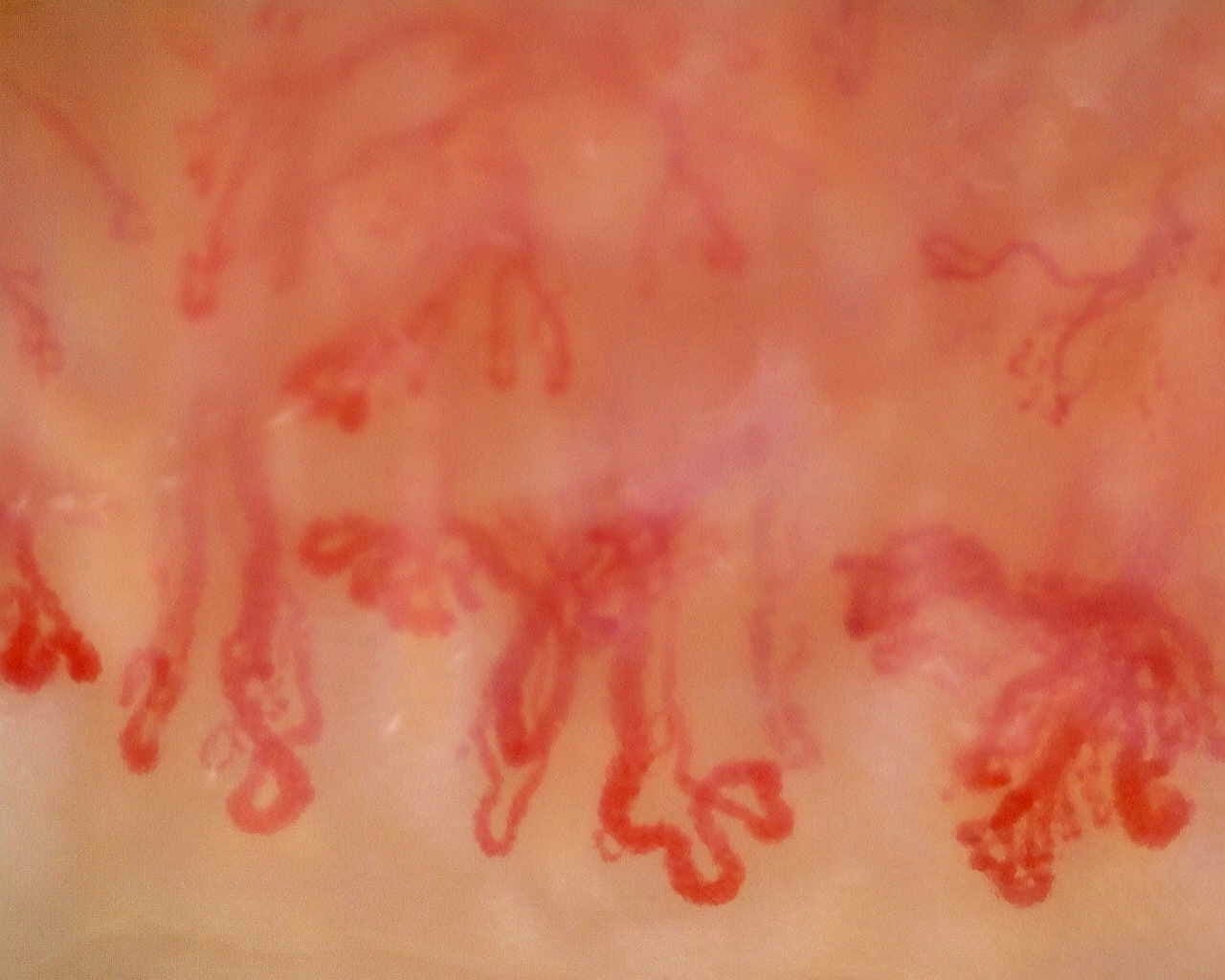 Nailfold capillaroscopy: left middle finger, field d. Anti-Mi2β Dermatomyositis in Active Disease.