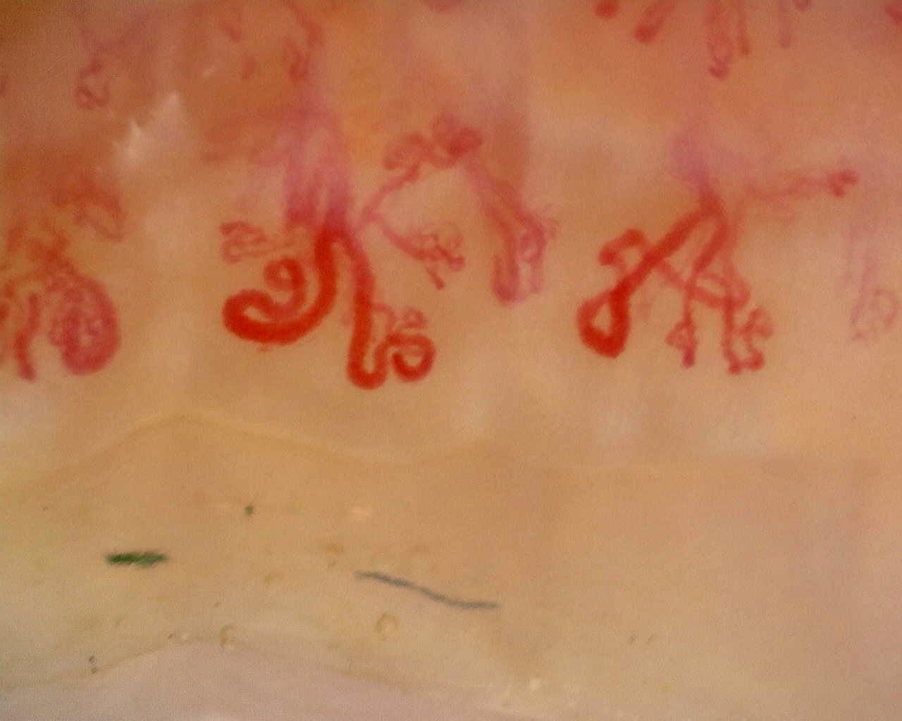 Nailfold capillaroscopy: left index finger, field c. Anti-Mi2β Dermatomyositis in Active Disease.