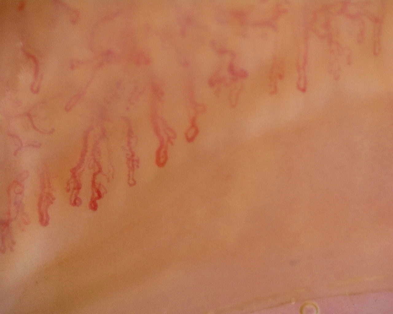 Nailfold capillaroscopy: left ring finger, field a. Anti-Mi2β Dermatomyositis in Active Disease.