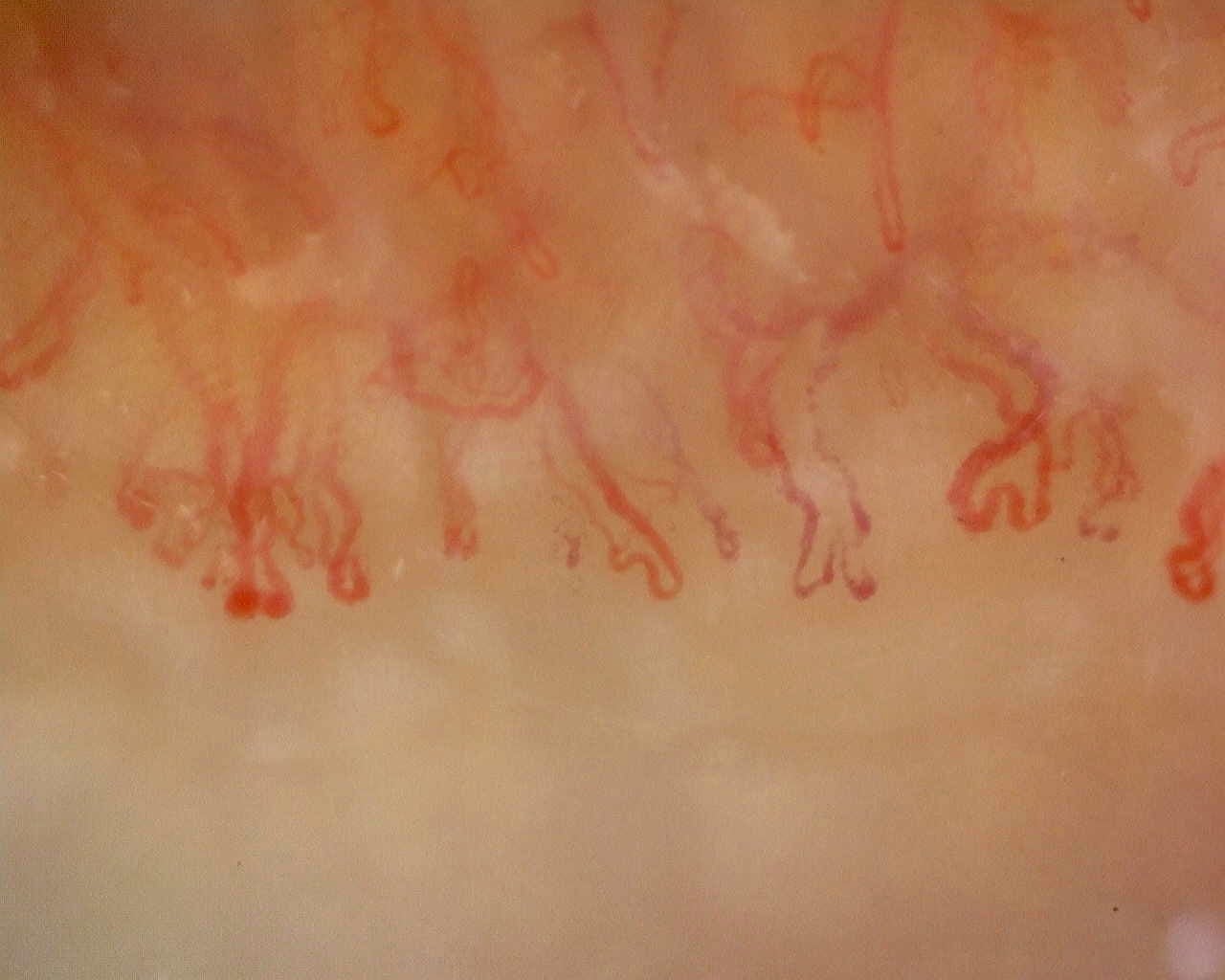 Nailfold capillaroscopy: right little finger, field b. Anti-Mi2β Dermatomyositis in Active Disease.