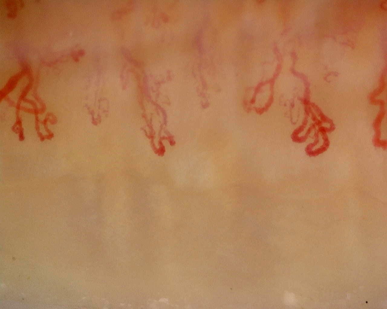 Nailfold capillaroscopy: left index finger, field d. Anti-Mi2β Dermatomyositis in Active Disease.
