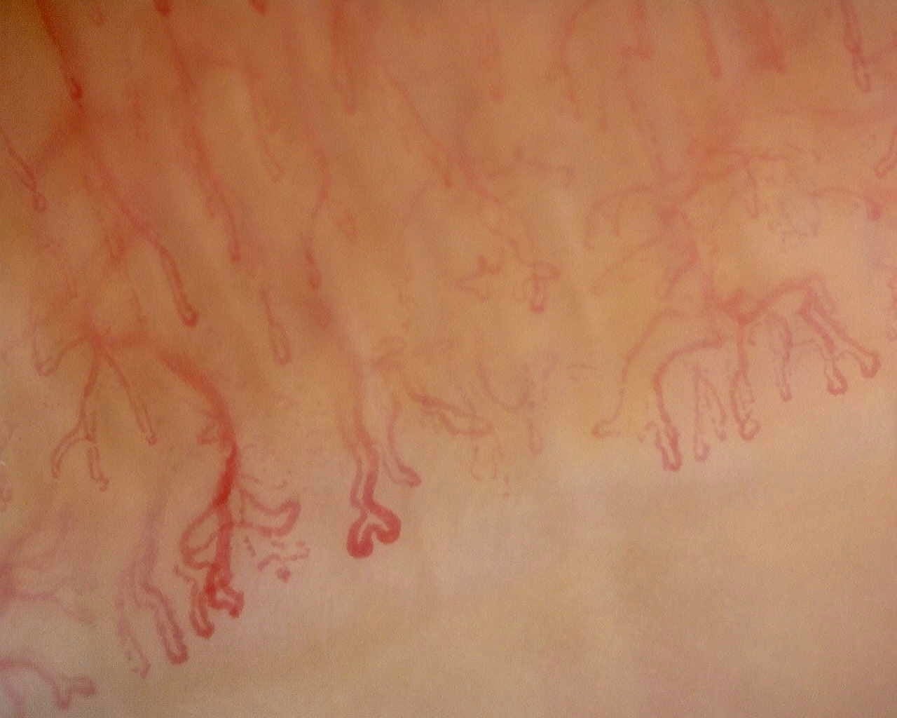 Nailfold capillaroscopy: left little finger, field d. Anti-Mi2β Dermatomyositis in Active Disease.