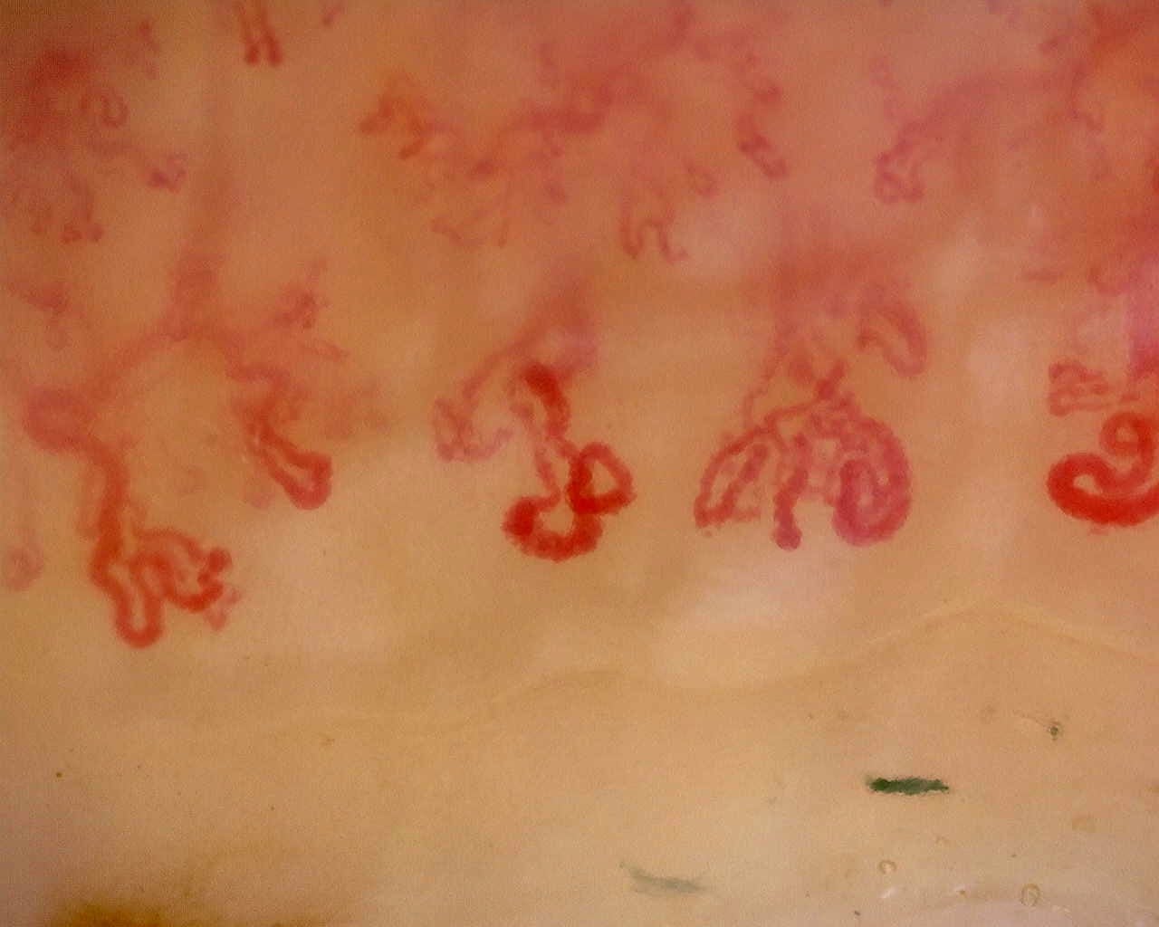 Nailfold capillaroscopy: left index finger, field b. Anti-Mi2β Dermatomyositis in Active Disease.
