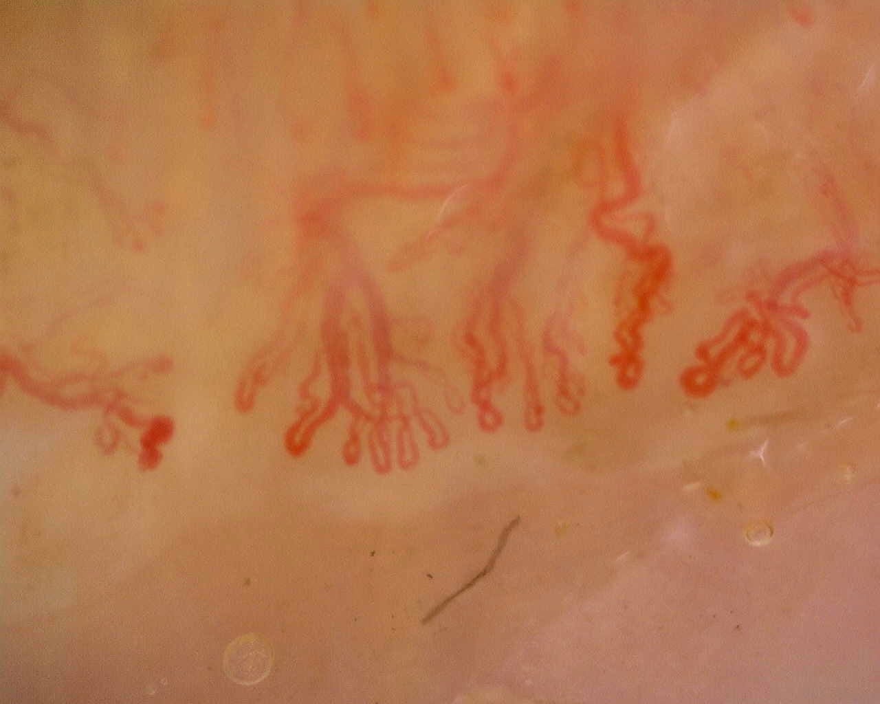 Nailfold capillaroscopy: left ring finger, field d. Anti-Mi2β Dermatomyositis in Active Disease.