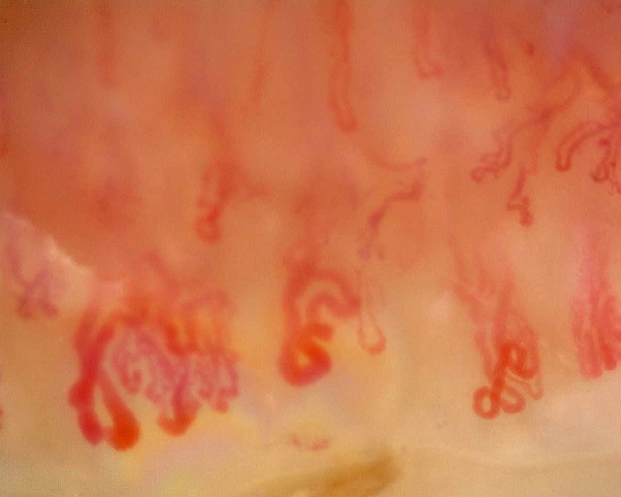 Nailfold capillaroscopy: right middle finger, field c. Anti-Mi2β Dermatomyositis in Active Disease.