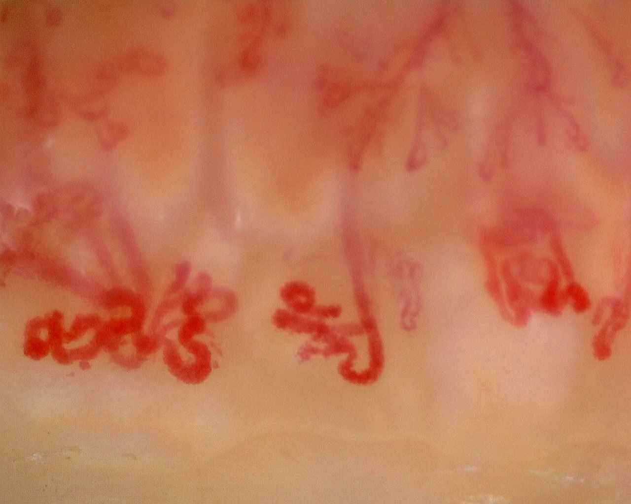 Nailfold capillaroscopy: left middle finger, field c. Anti-Mi2β Dermatomyositis in Active Disease.