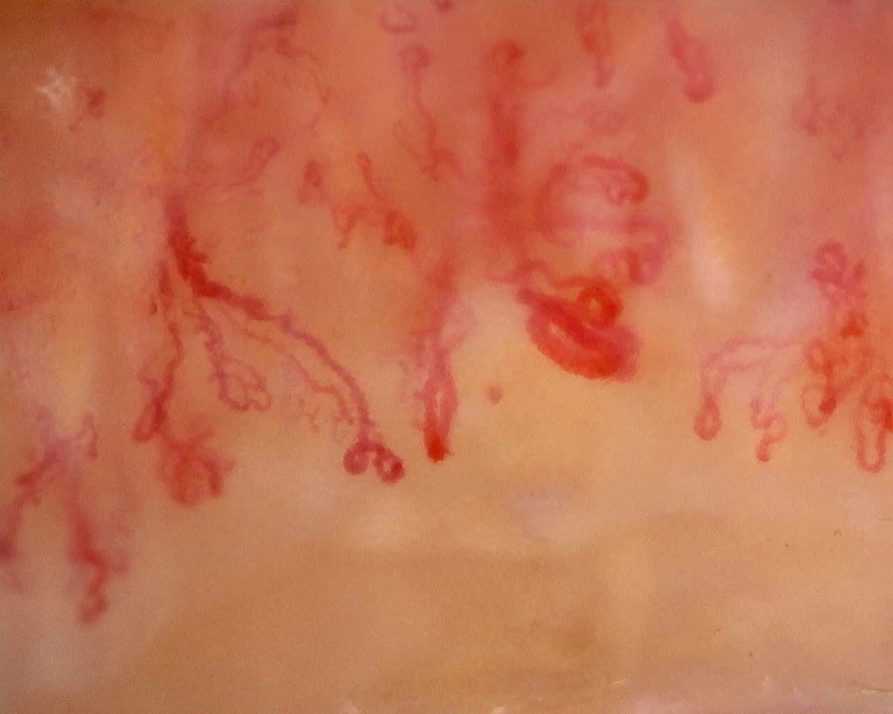 Nailfold capillaroscopy: left middle finger, field a. Anti-Mi2β Dermatomyositis in Active Disease.