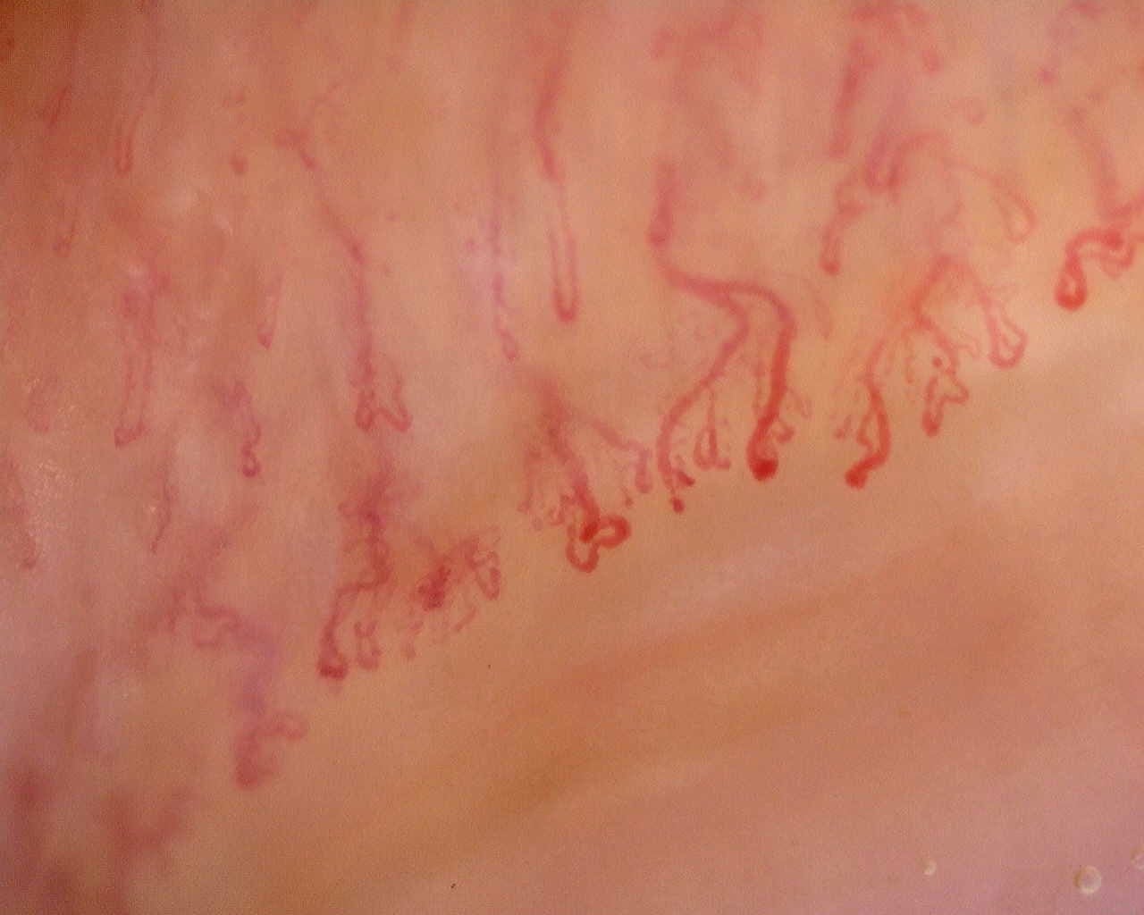 Nailfold capillaroscopy: left little finger, field a. Anti-Mi2β Dermatomyositis in Active Disease.