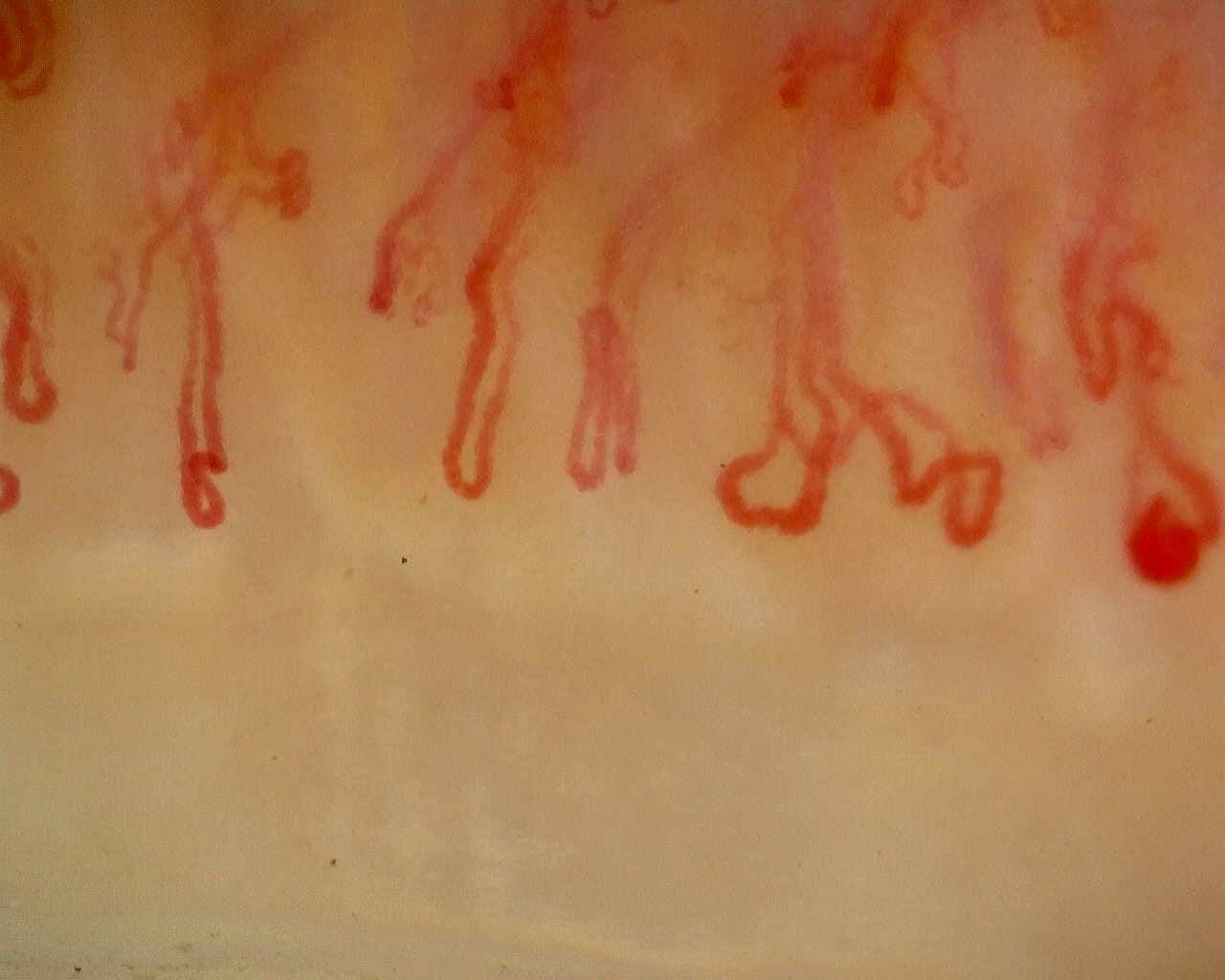 Nailfold capillaroscopy: right index finger, field b. Anti-Mi2β Dermatomyositis in Active Disease.