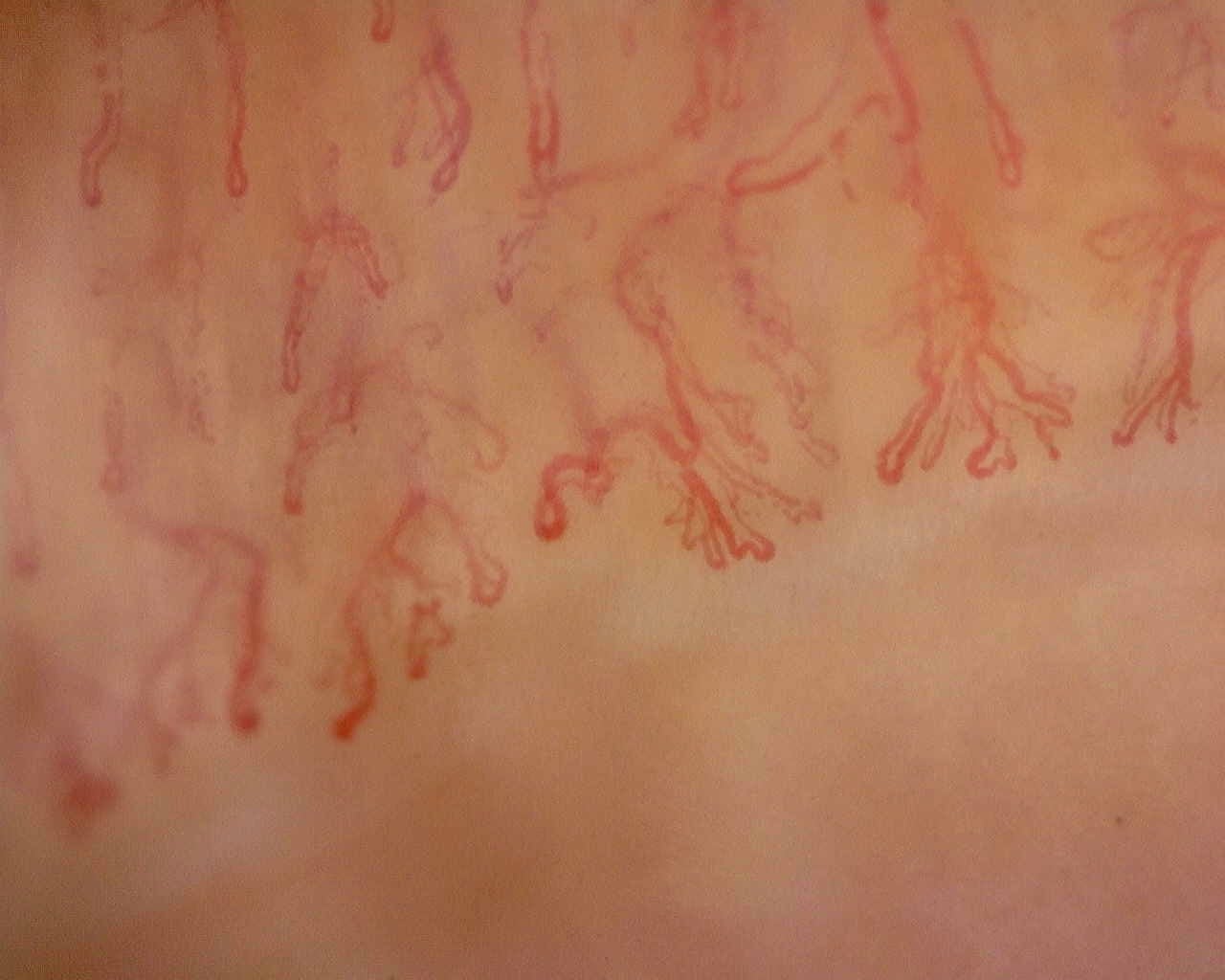 Nailfold capillaroscopy: left little finger, field b. Anti-Mi2β Dermatomyositis in Active Disease.