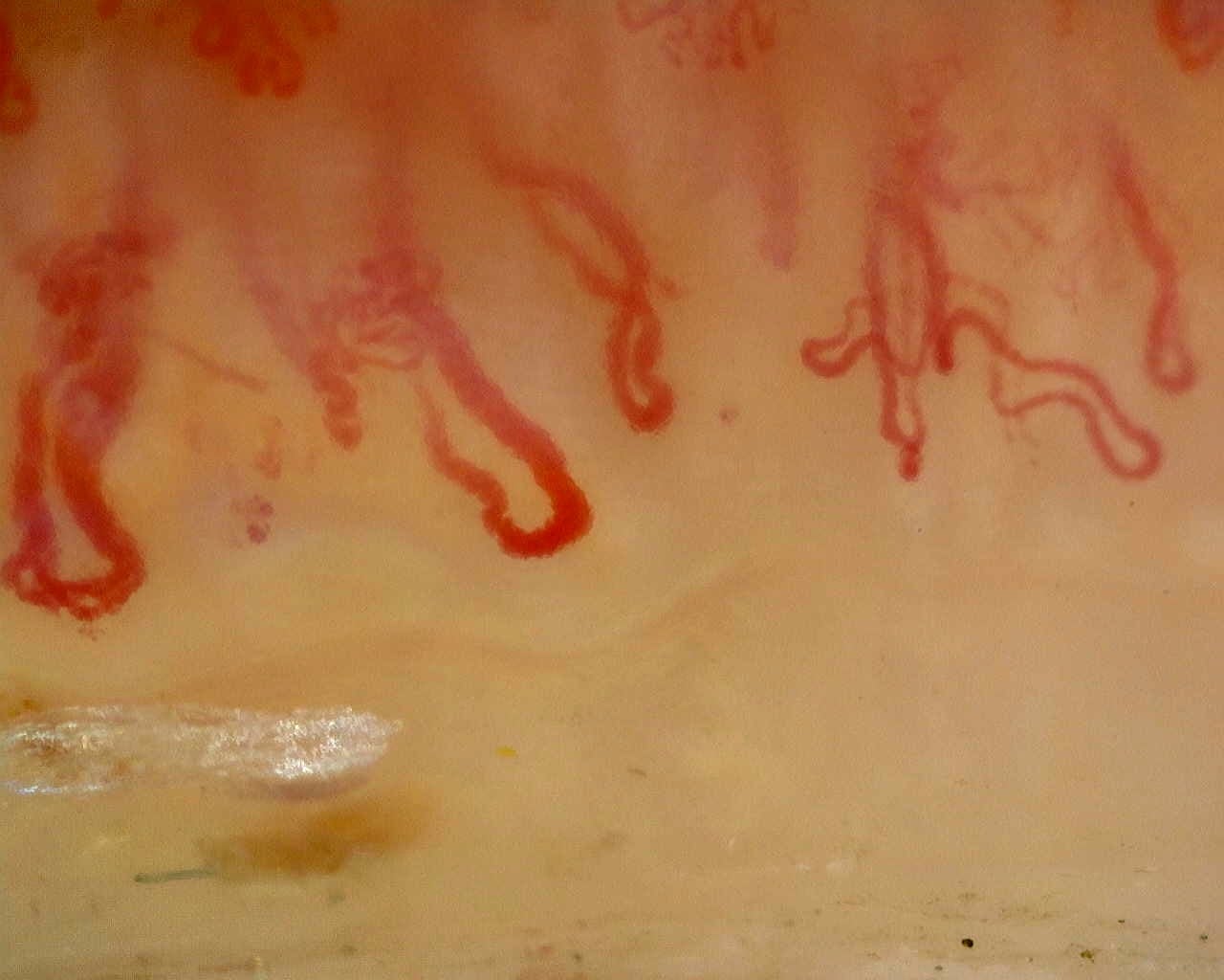 Nailfold capillaroscopy: right index finger, field c. Anti-Mi2β Dermatomyositis in Active Disease.