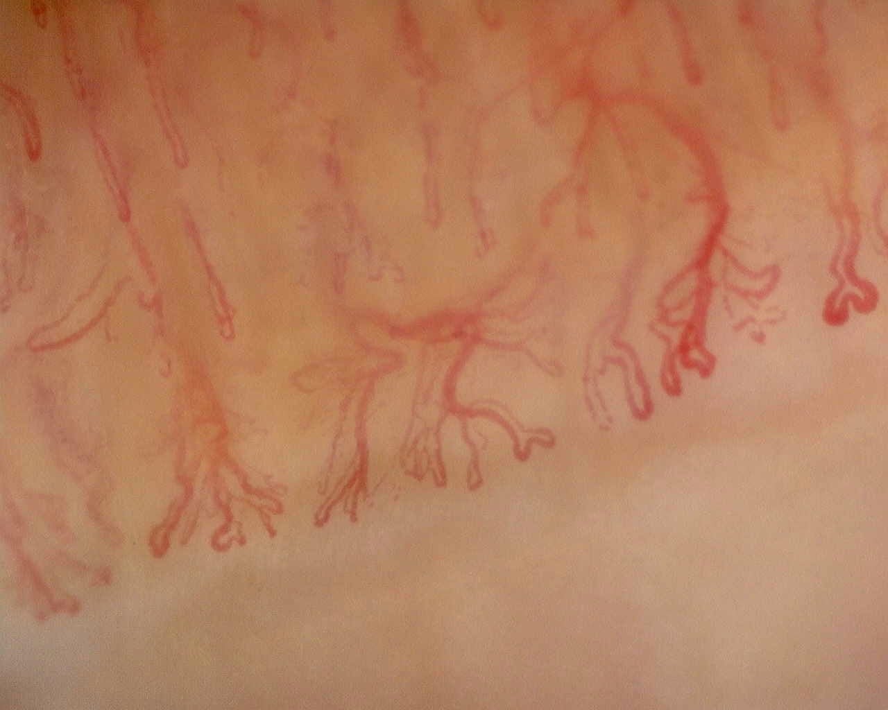 Nailfold capillaroscopy: left little finger, field c. Anti-Mi2β Dermatomyositis in Active Disease.