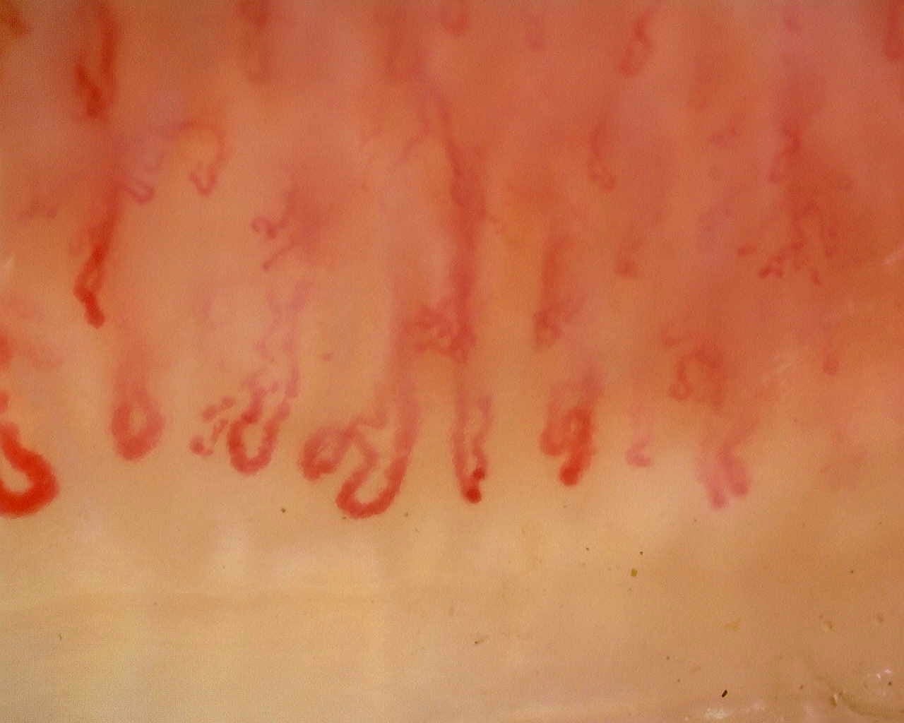 Nailfold capillaroscopy: right middle finger, field a. Anti-Mi2β Dermatomyositis in Active Disease.