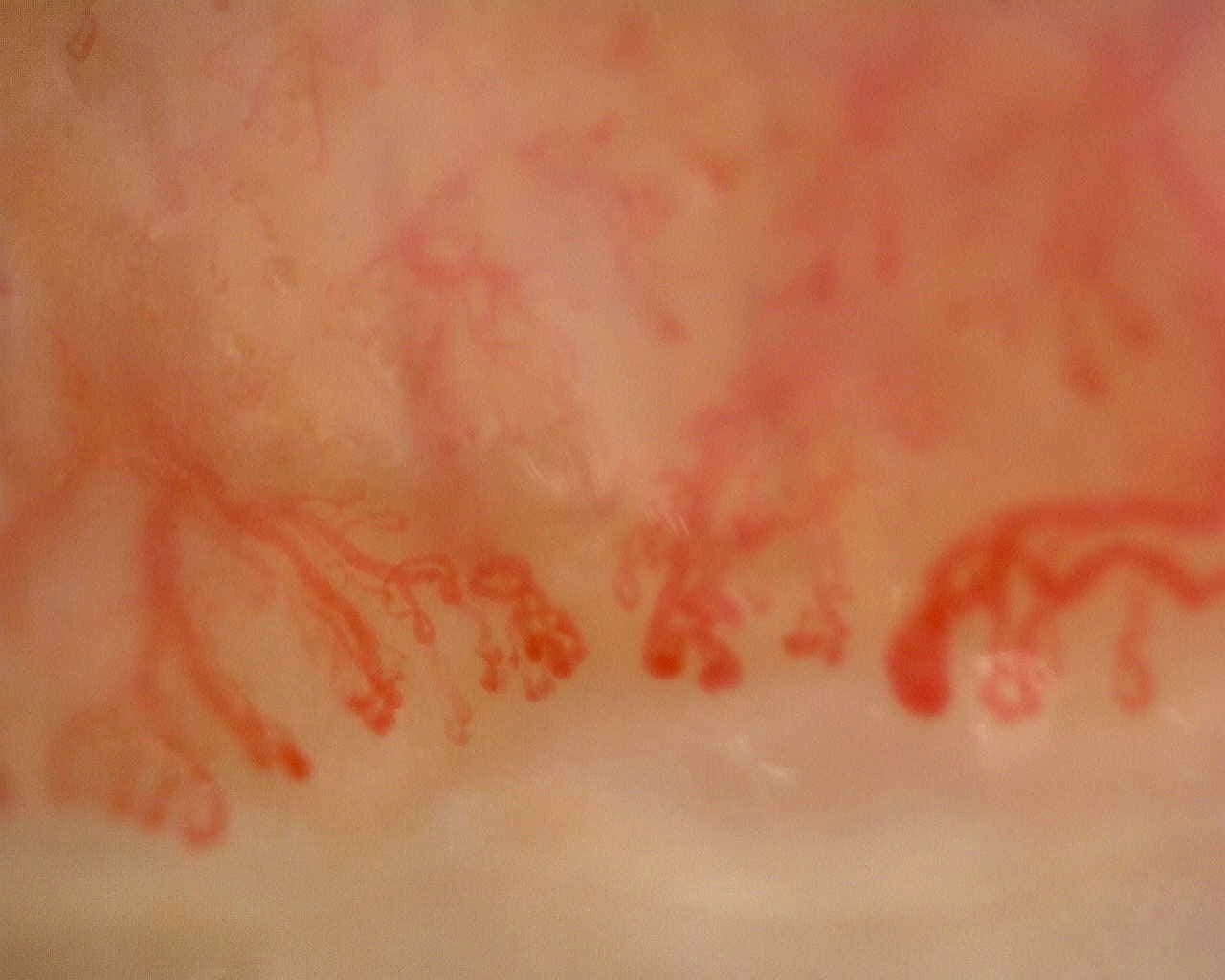Nailfold capillaroscopy: right little finger, field d. Anti-Mi2β Dermatomyositis in Active Disease.