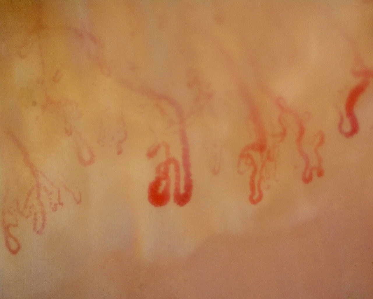 Nailfold capillaroscopy: left ring finger, field c. Anti-Mi2β Dermatomyositis in Active Disease.