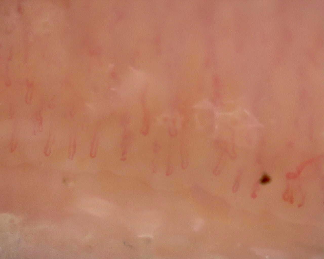Nailfold capillaroscopy: left middle finger, field a. Follow-up study. Juvenile Dermatomyositis anti-NXP2 with Capillaroscopic Improvement.