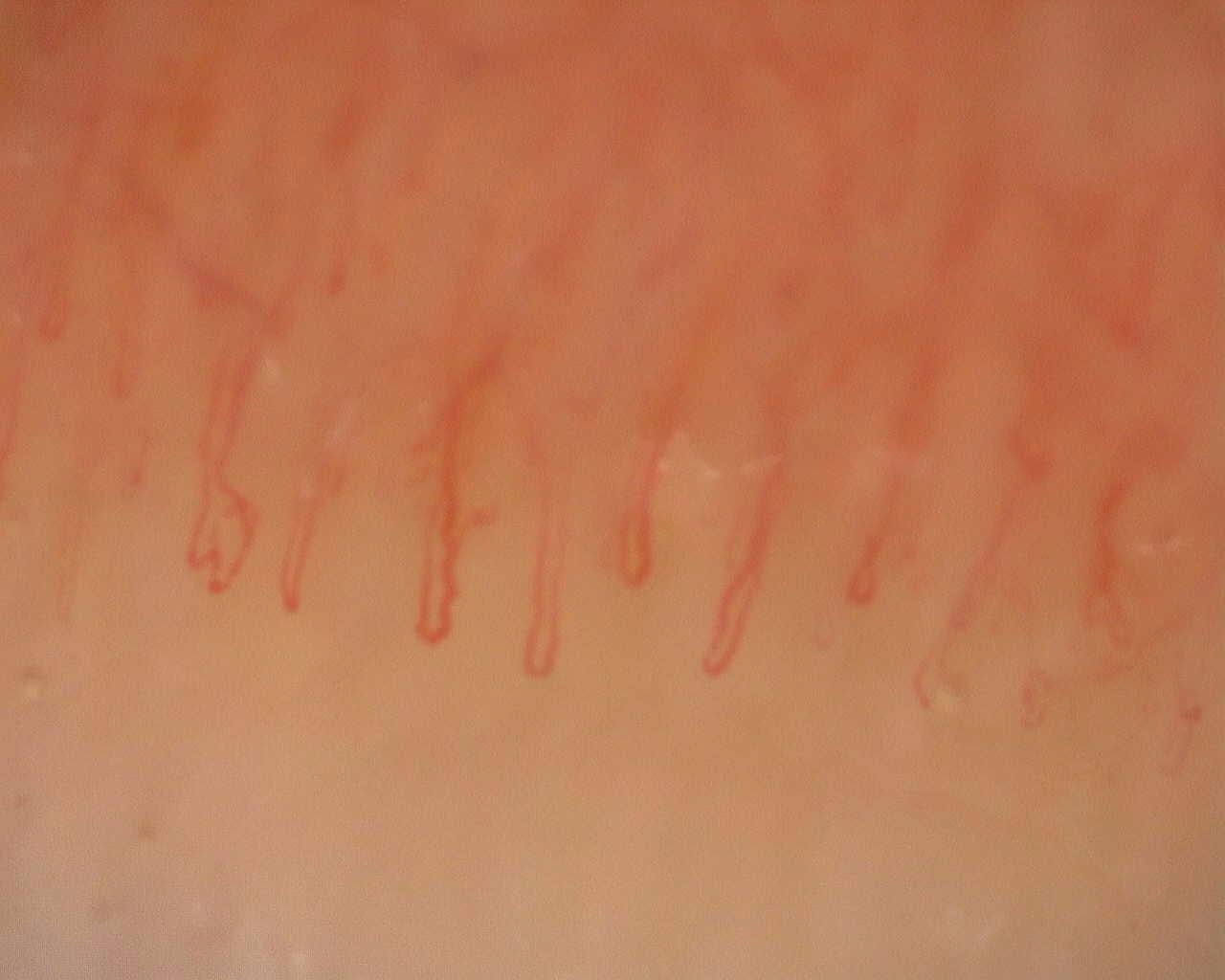 Nailfold capillaroscopy: left index finger, field a. Follow-up study. Juvenile Dermatomyositis anti-NXP2 with Capillaroscopic Improvement.
