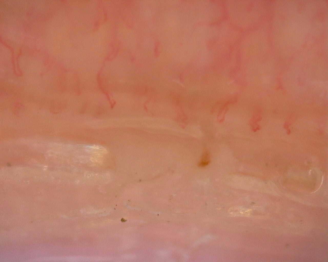 Nailfold capillaroscopy: right little finger, field a. Follow-up study. Juvenile Dermatomyositis anti-NXP2 with Capillaroscopic Improvement.