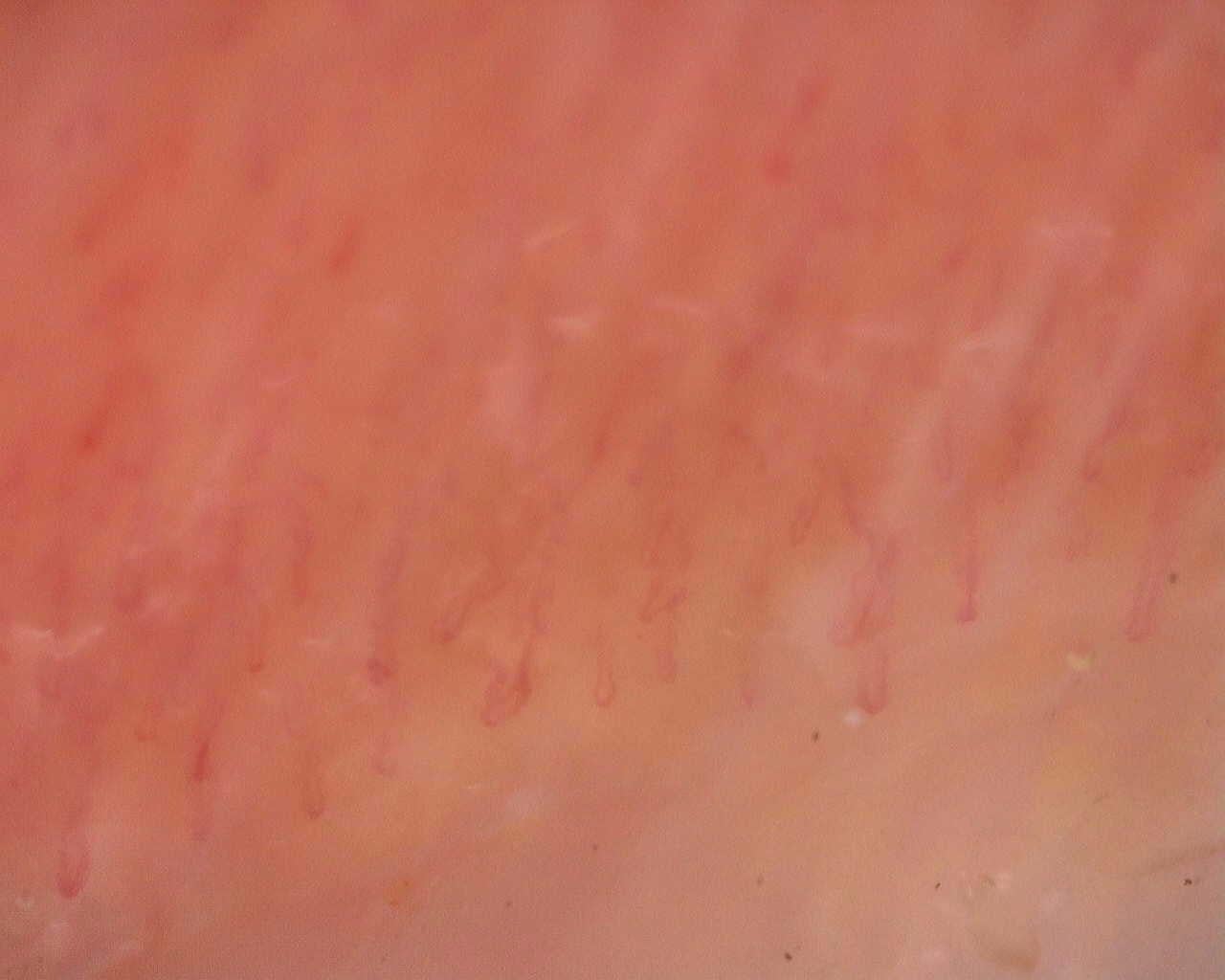 Nailfold capillaroscopy: left index finger, field a. Follow-up study. Juvenile Dermatomyositis anti-NXP2 with Capillaroscopic Improvement.